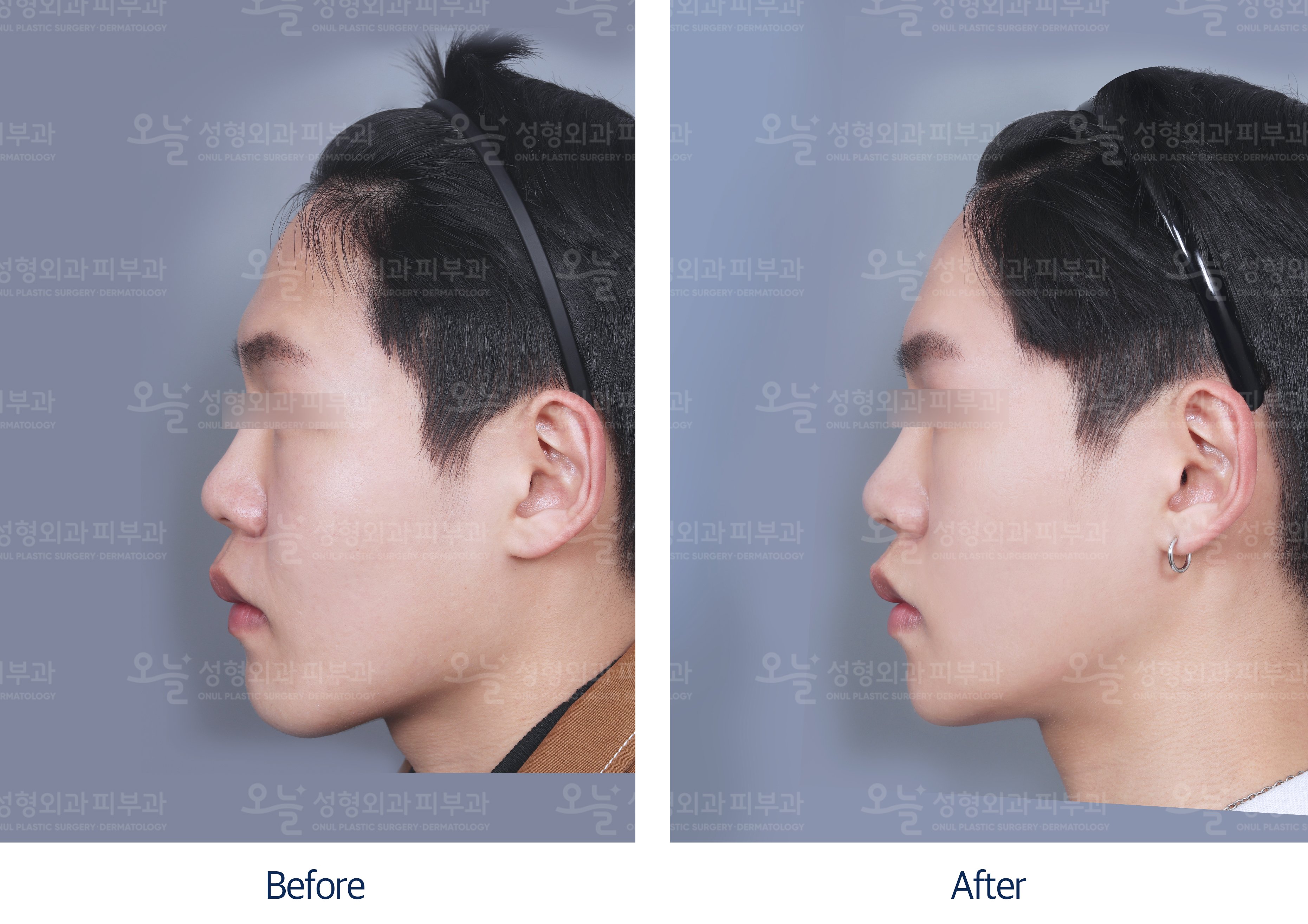 오늘성형외과 전후사진