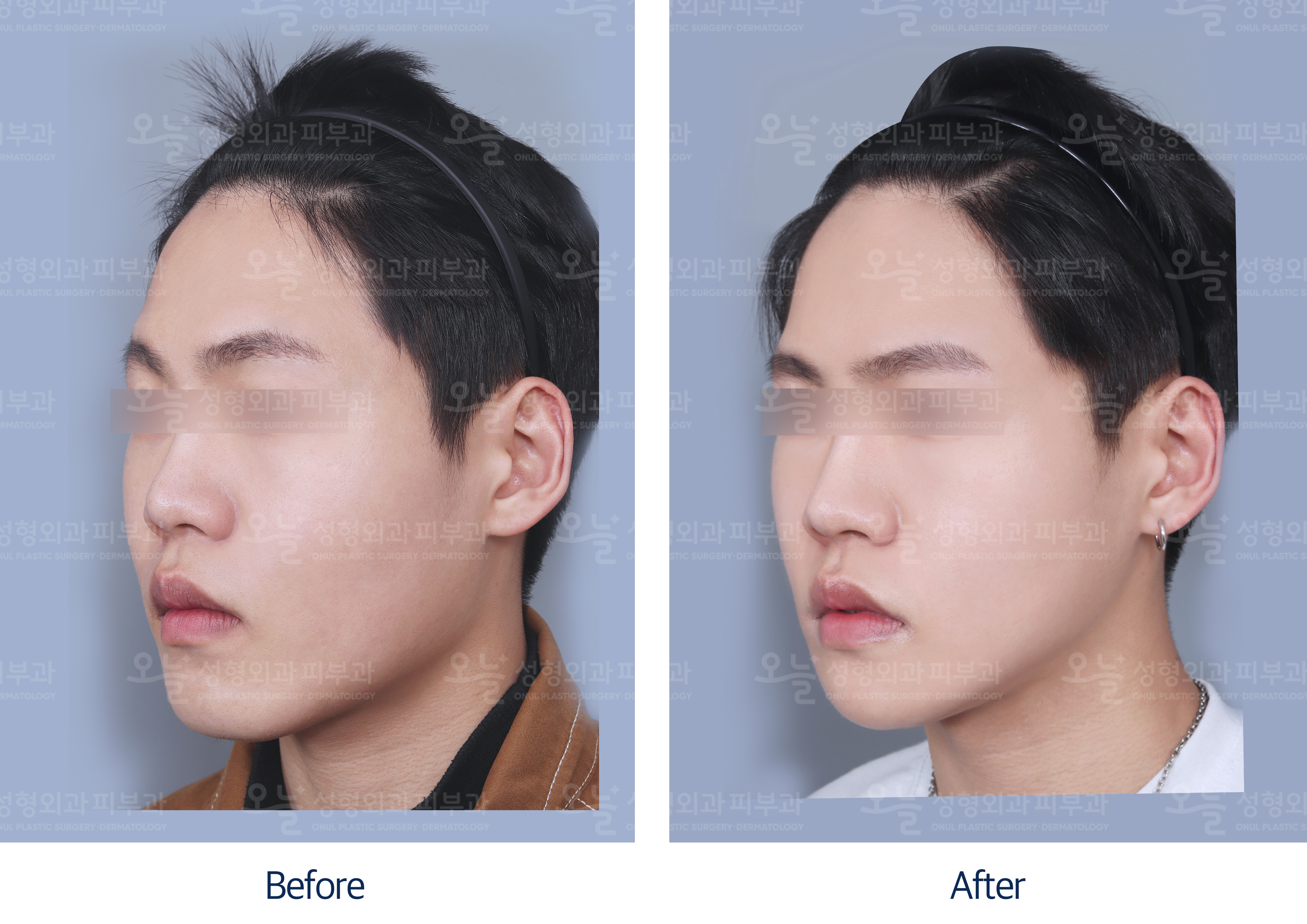 오늘성형외과 전후사진