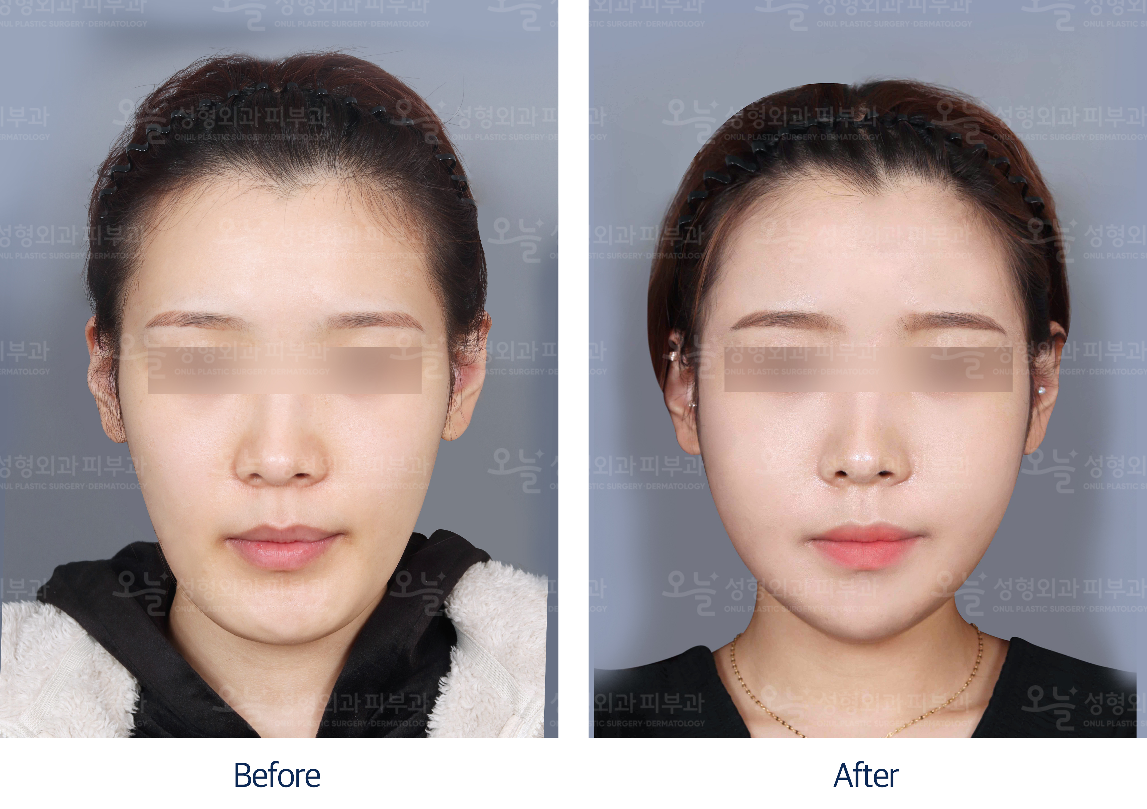 오늘성형외과 전후사진