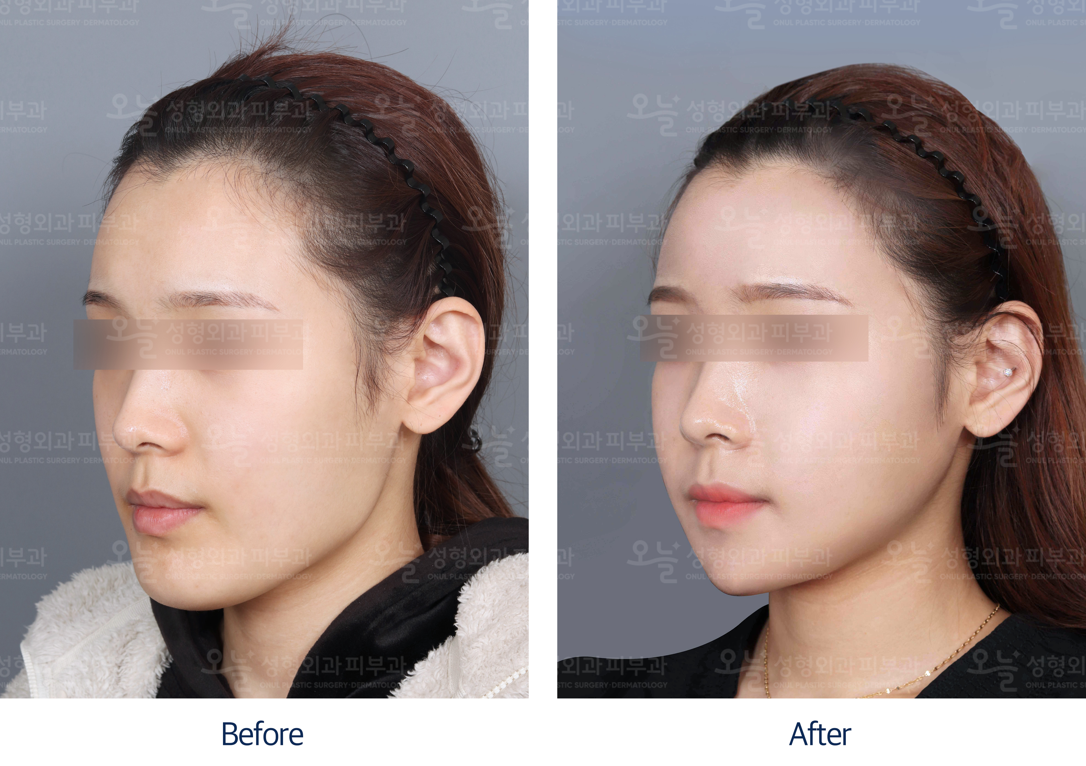 오늘성형외과 전후사진