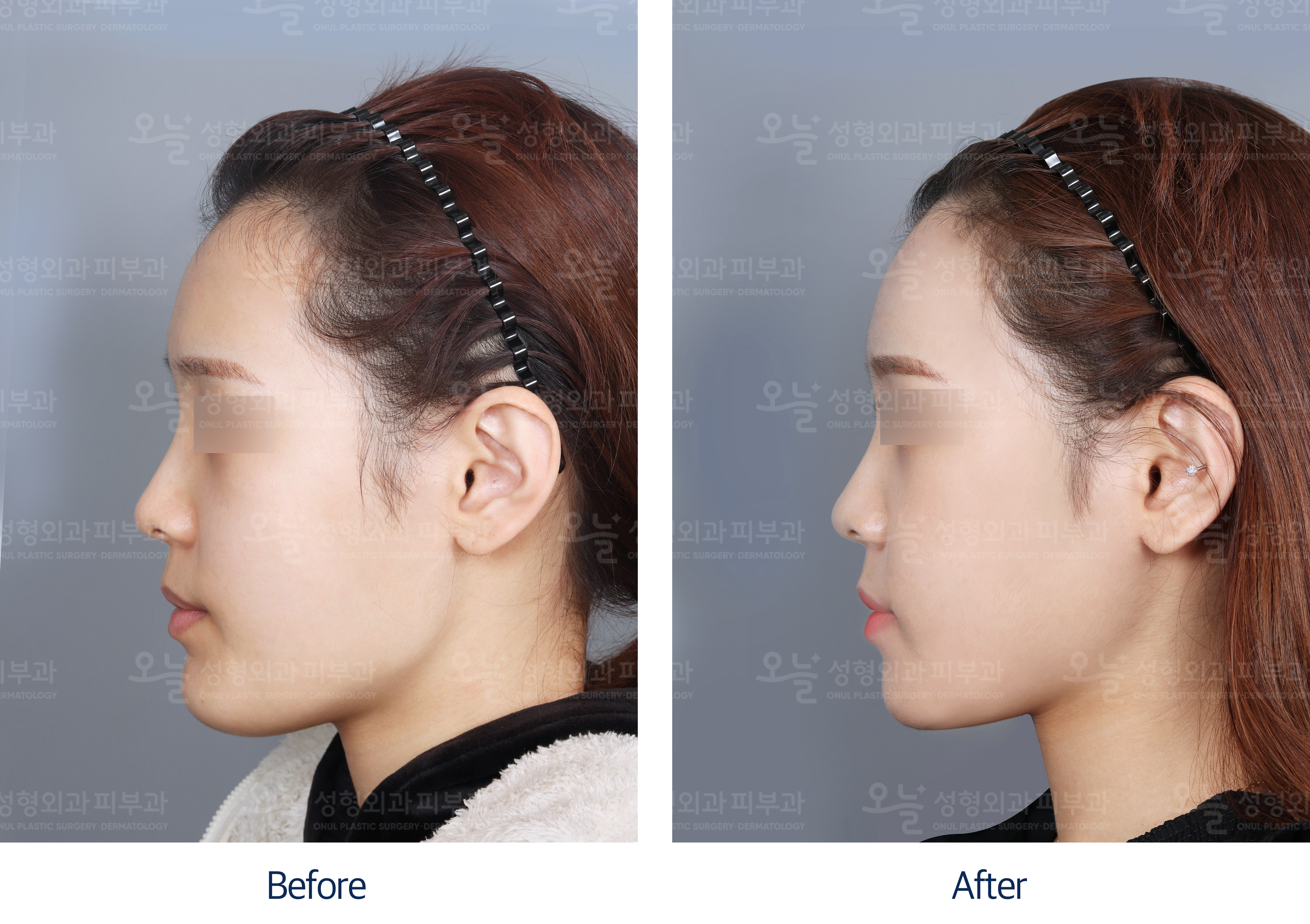 오늘성형외과 전후사진