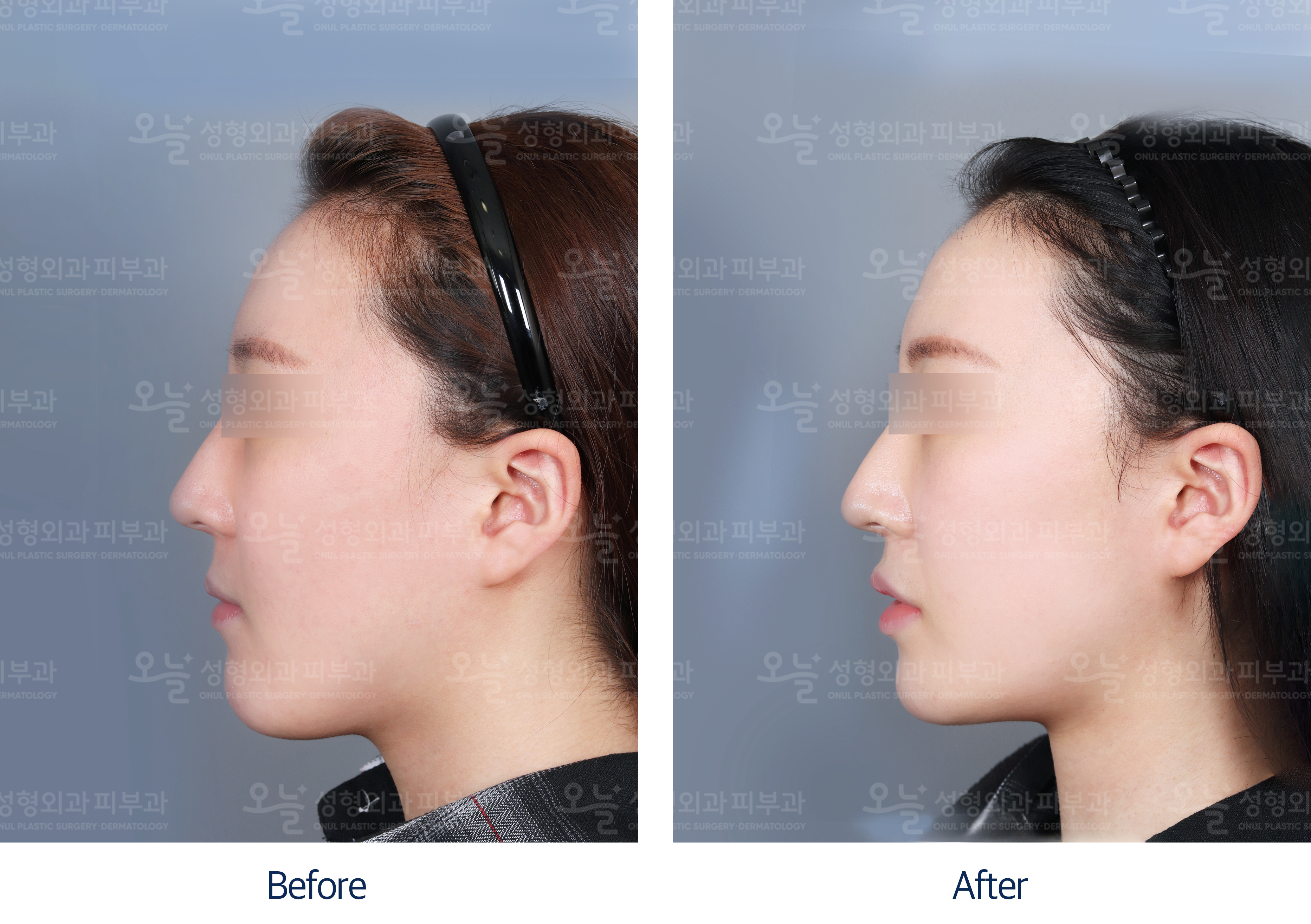 오늘성형외과 전후사진