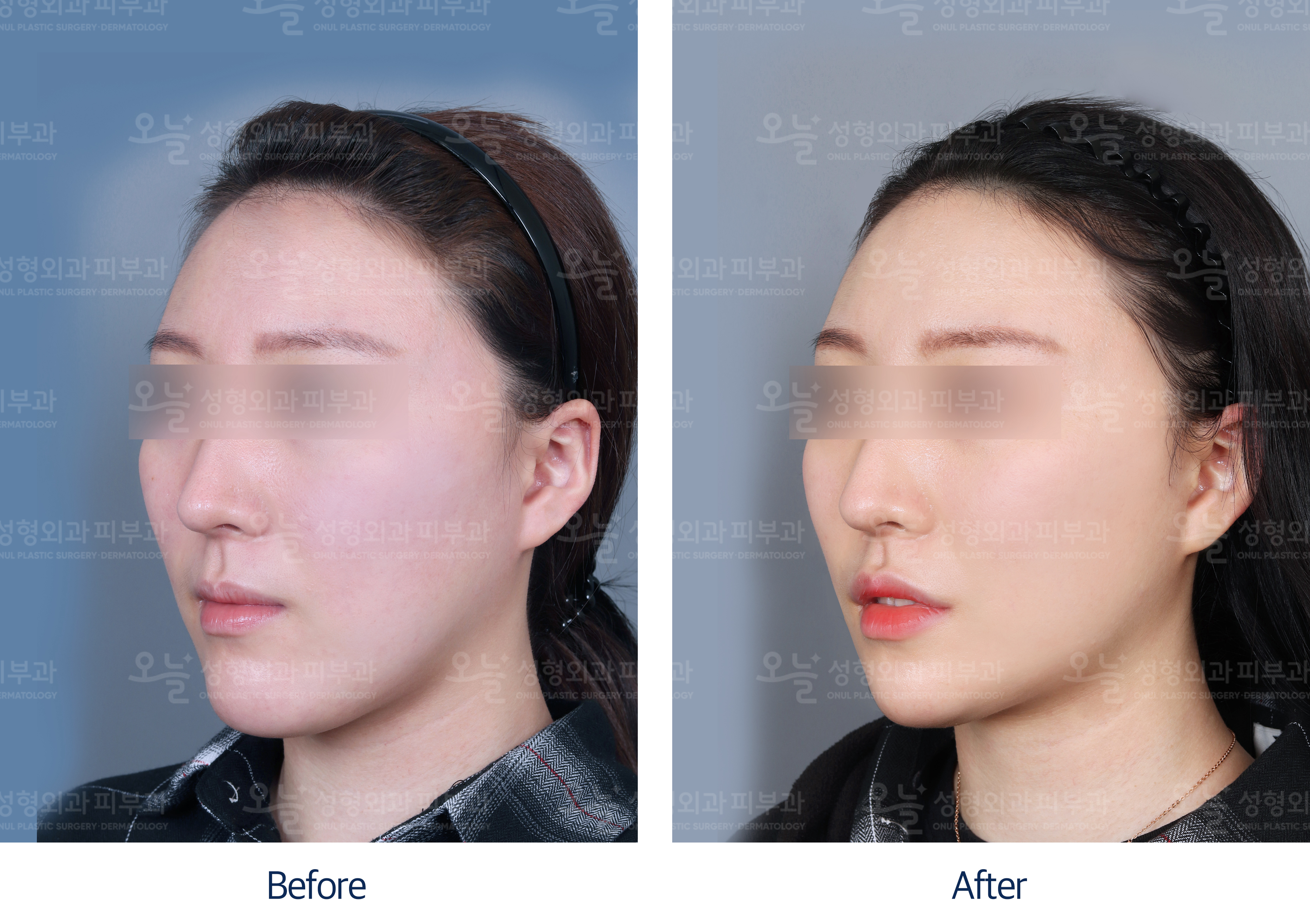 오늘성형외과 전후사진