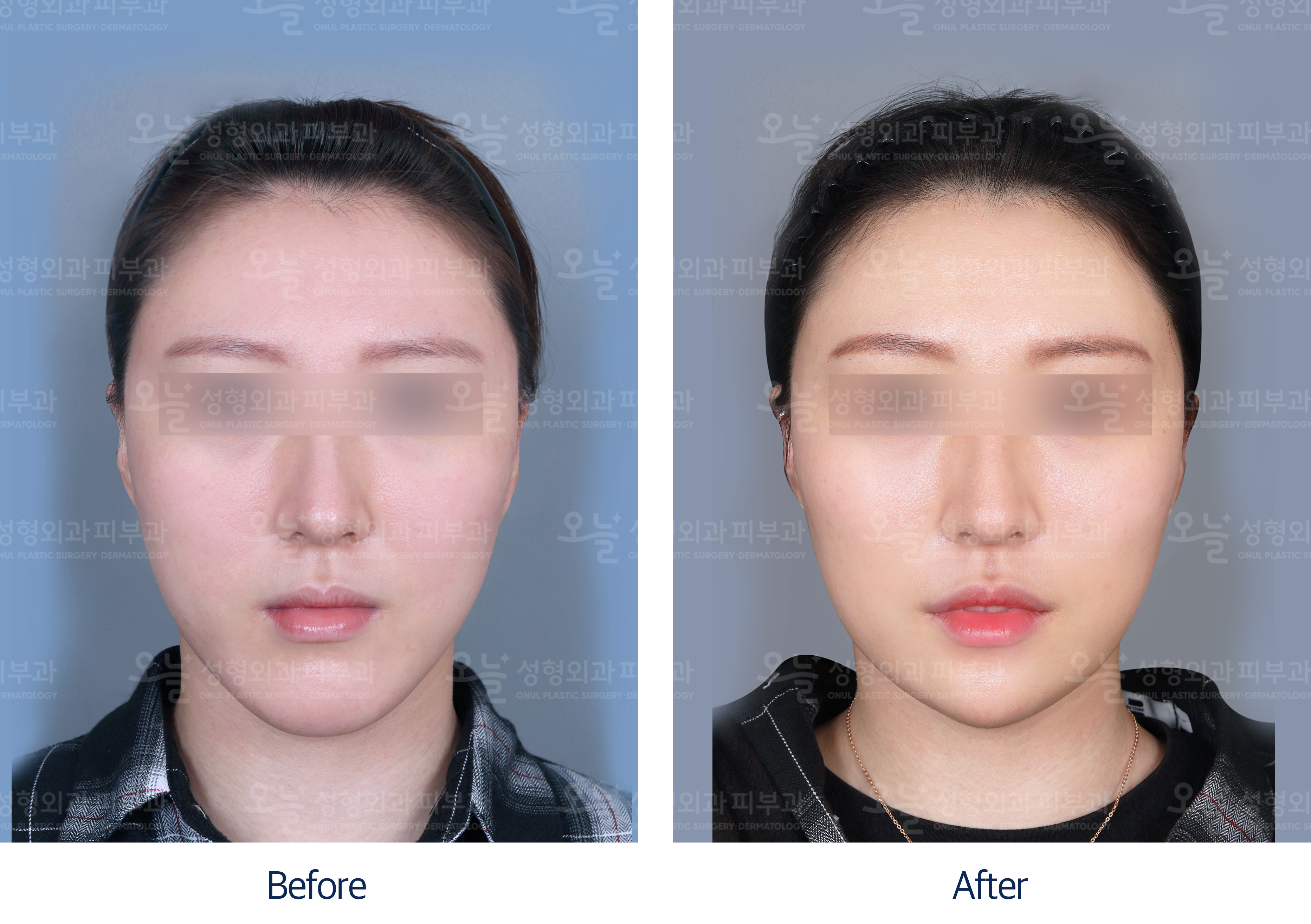 오늘성형외과 전후사진