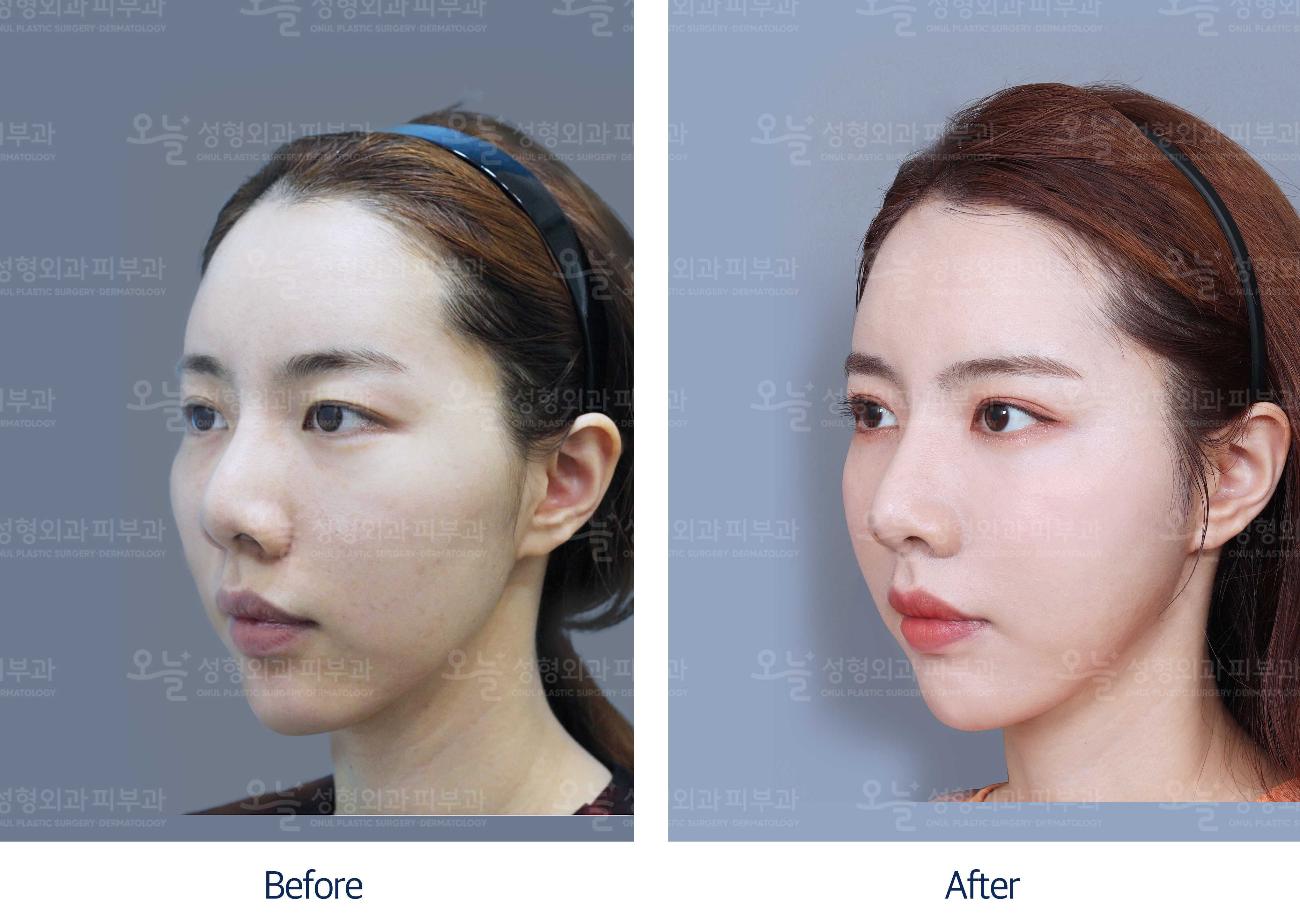 오늘성형외과 전후사진