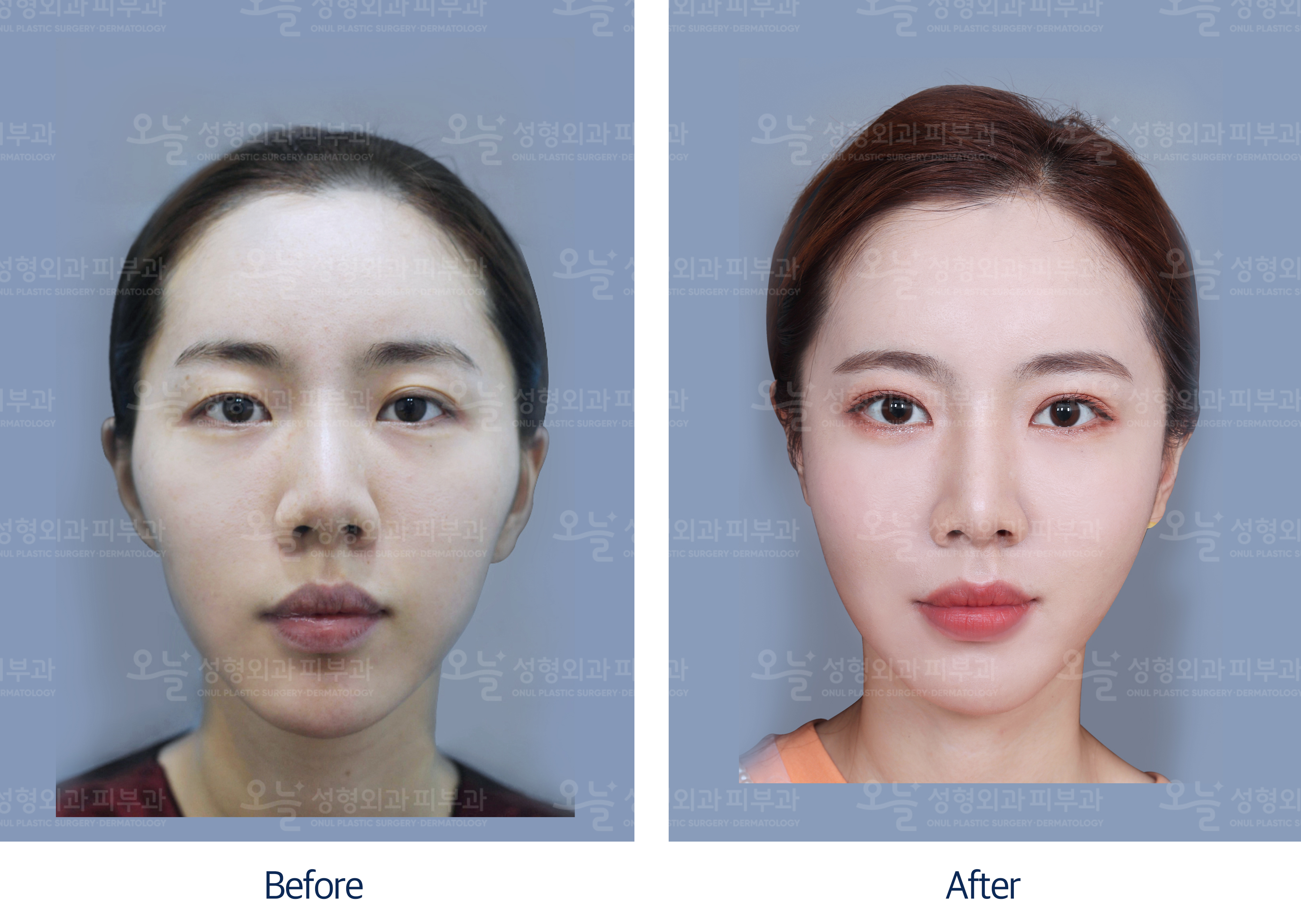 오늘성형외과 전후사진