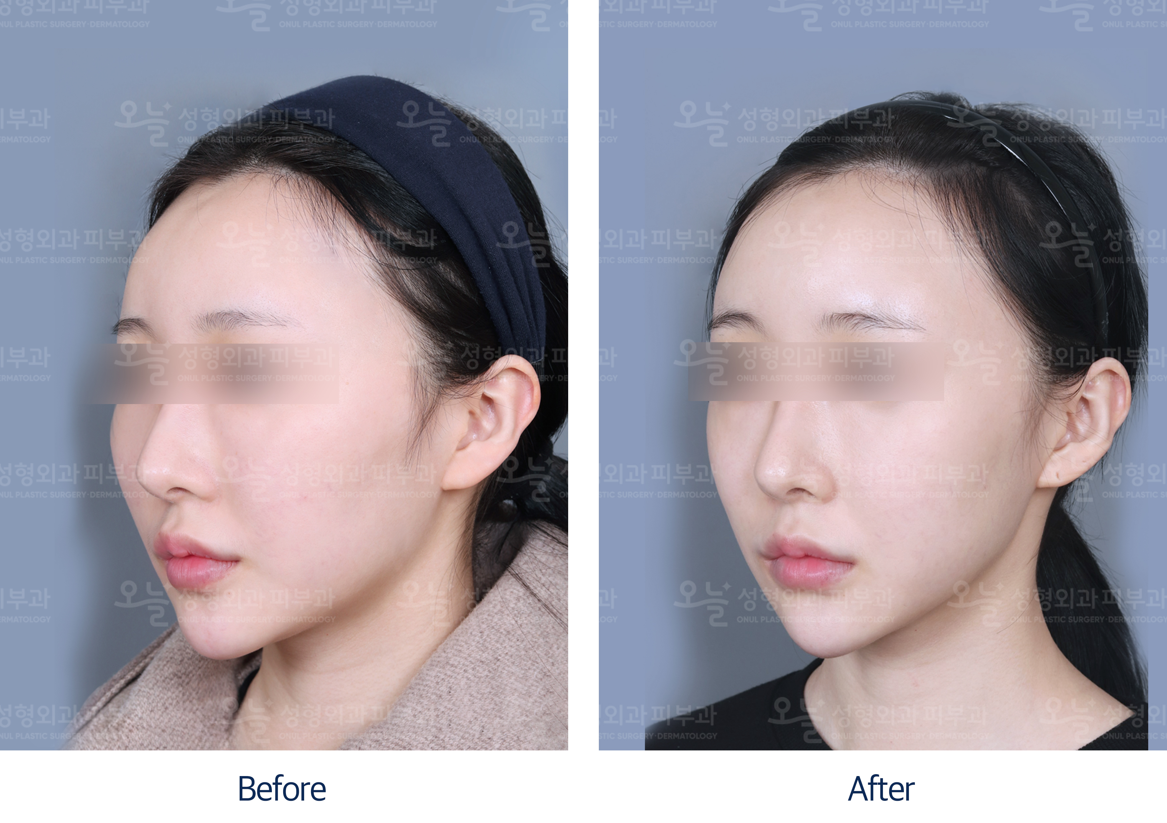 오늘성형외과 전후사진