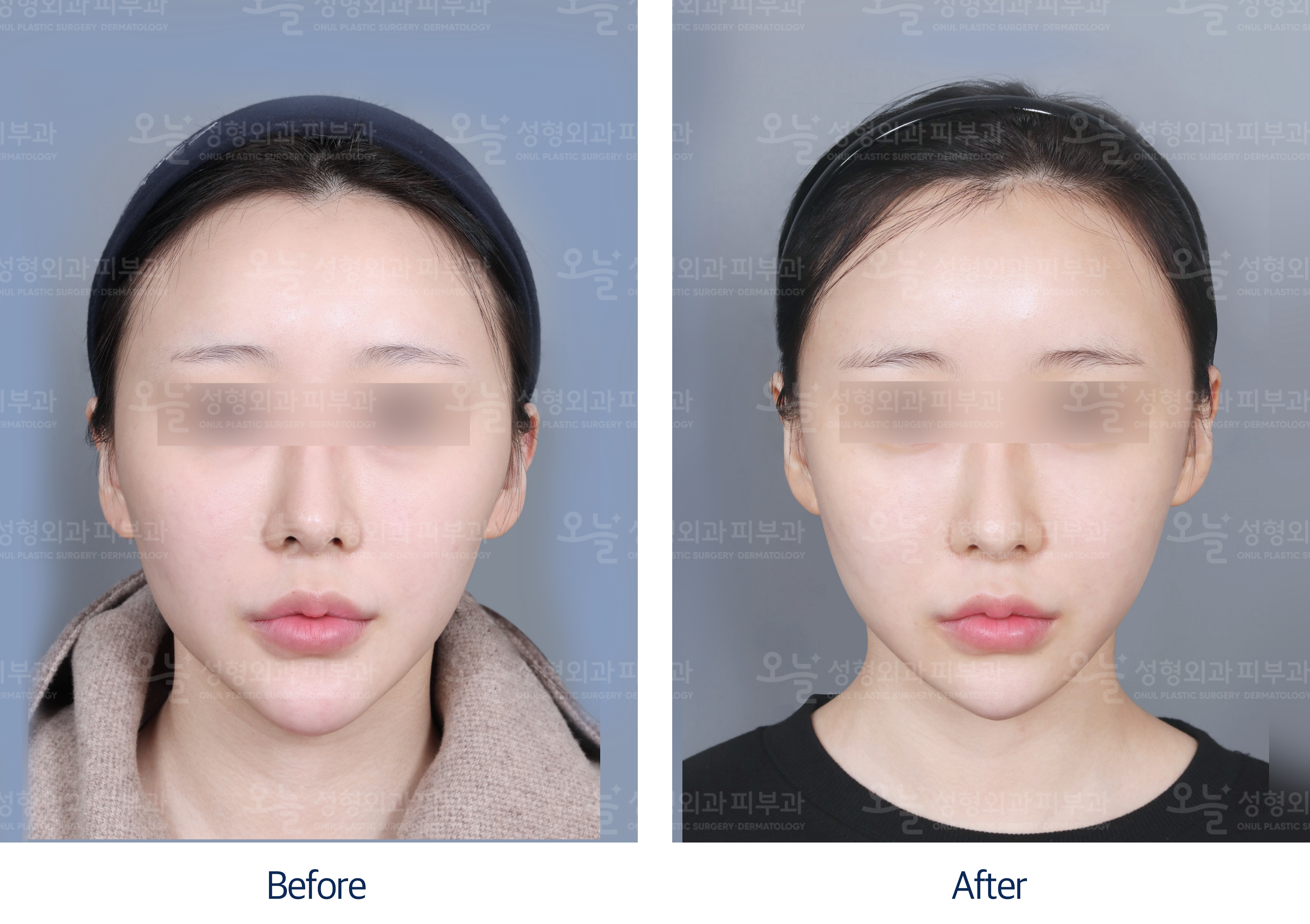 오늘성형외과 전후사진