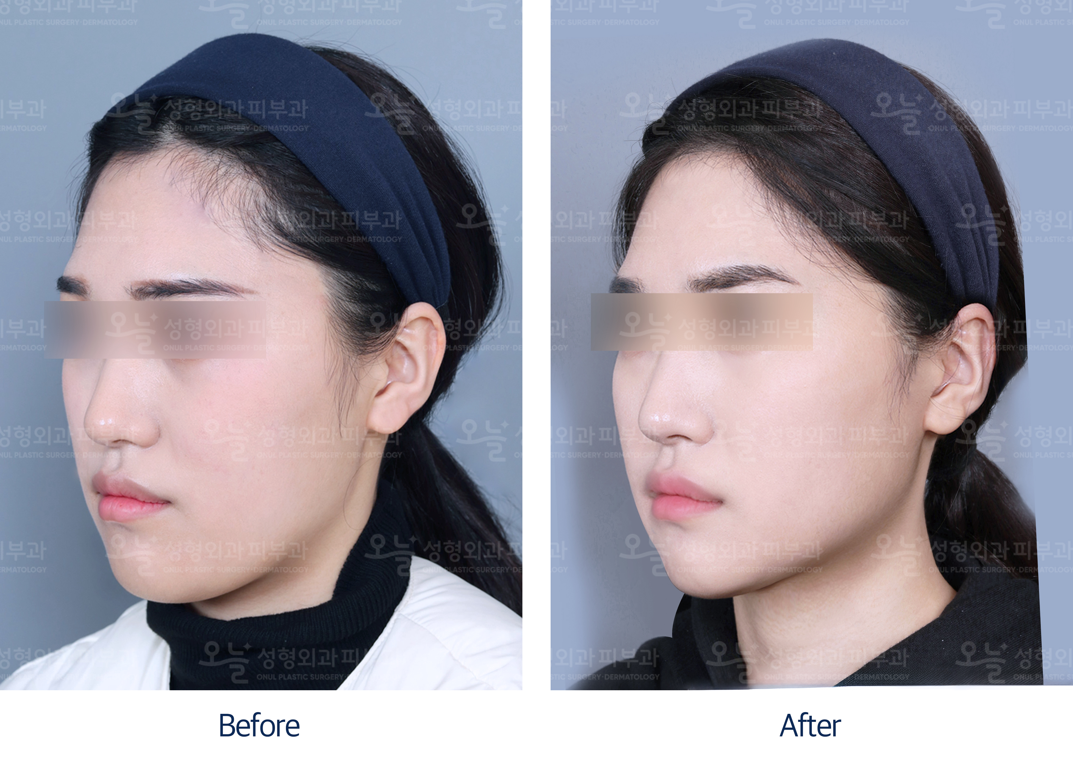 오늘성형외과 전후사진