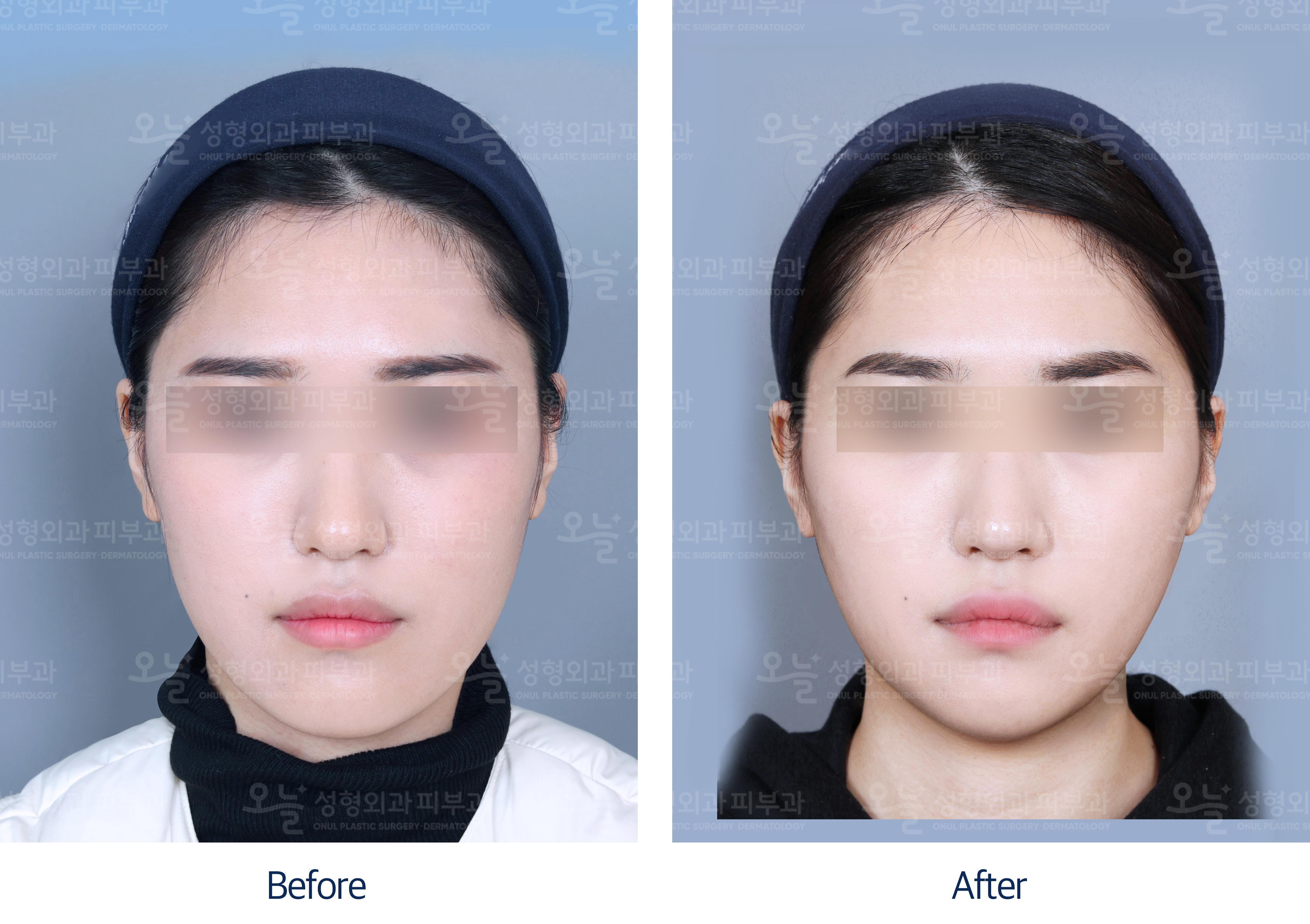 오늘성형외과 전후사진