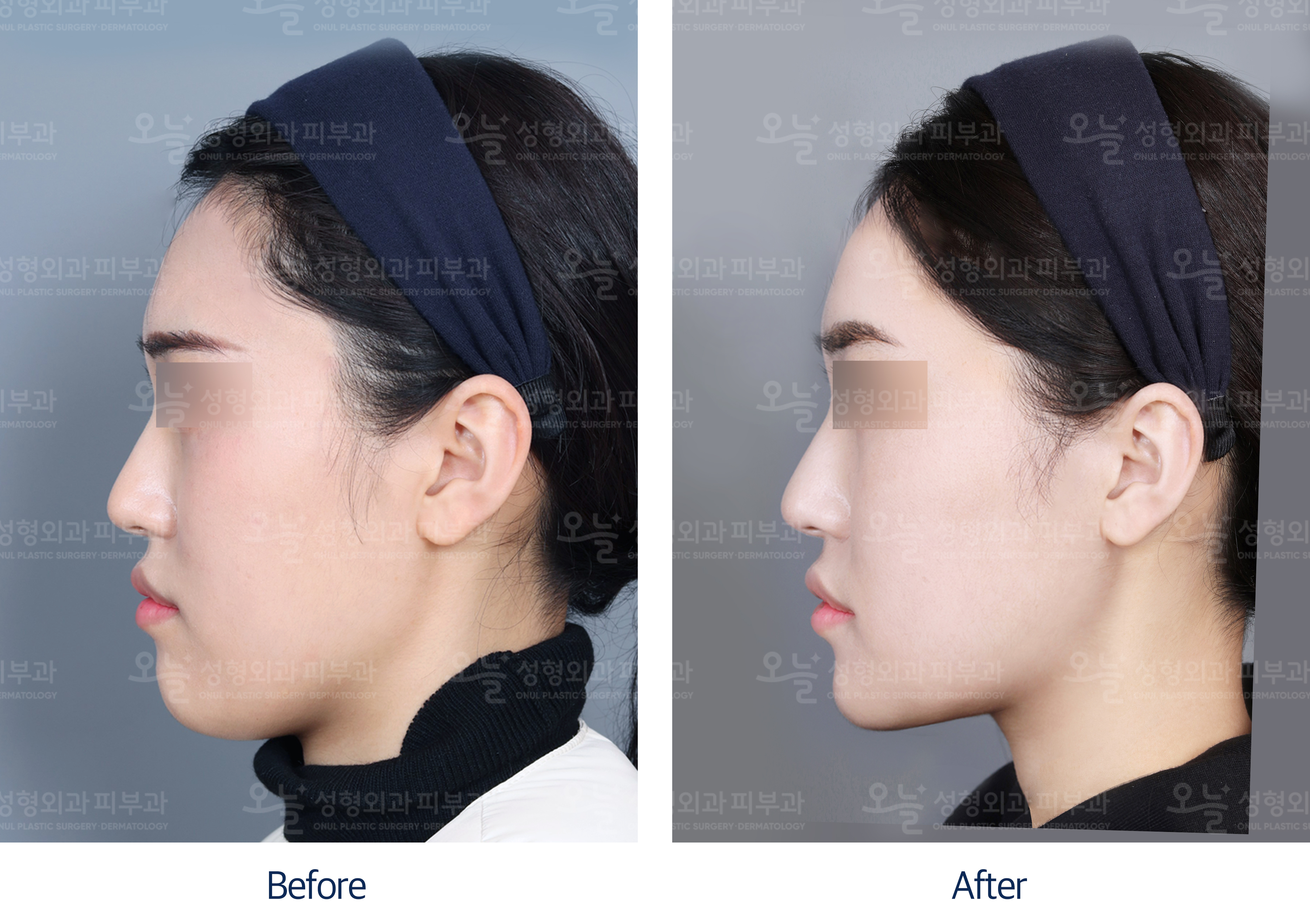 오늘성형외과 전후사진