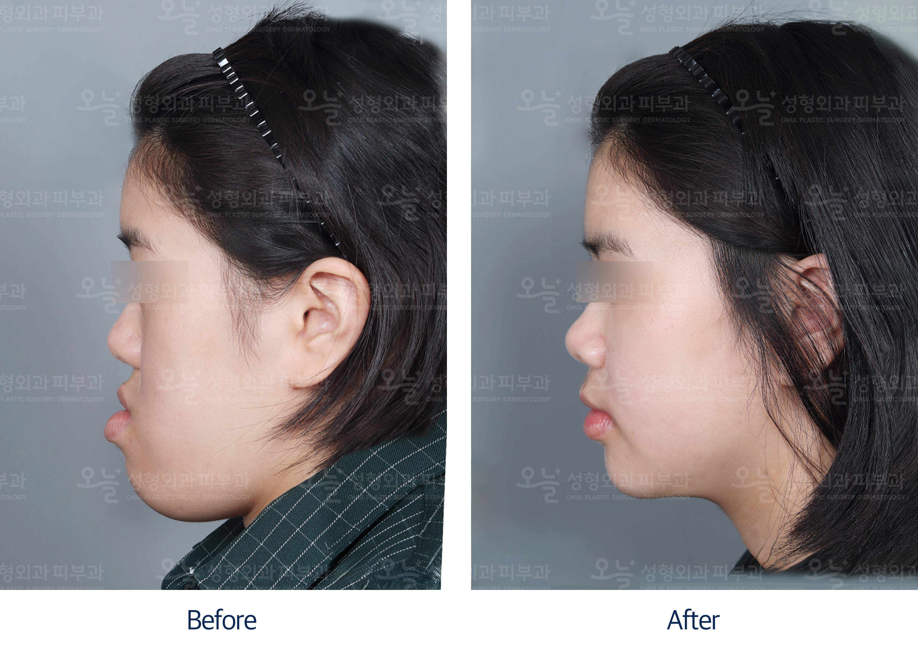 오늘성형외과 전후사진
