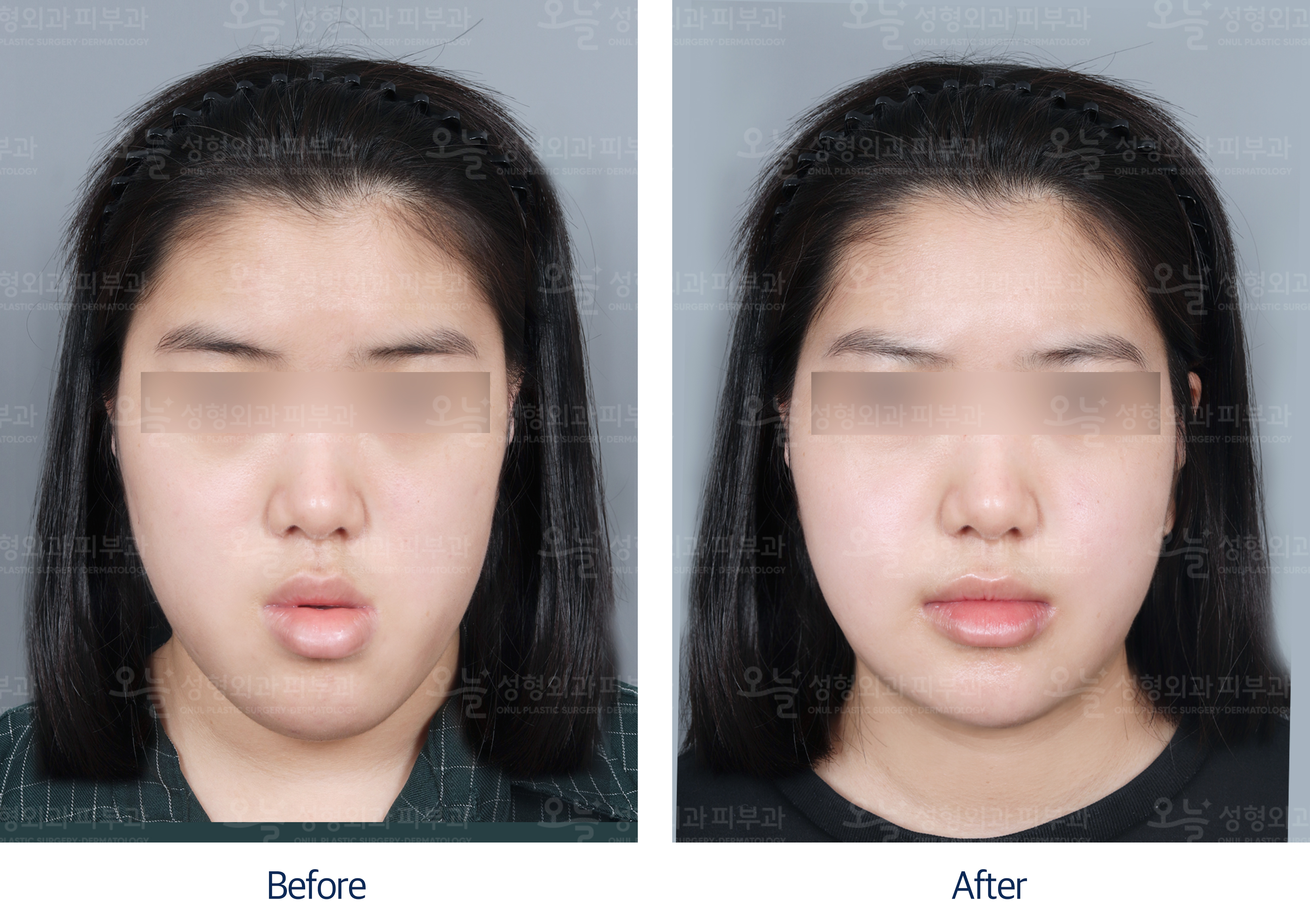 오늘성형외과 전후사진