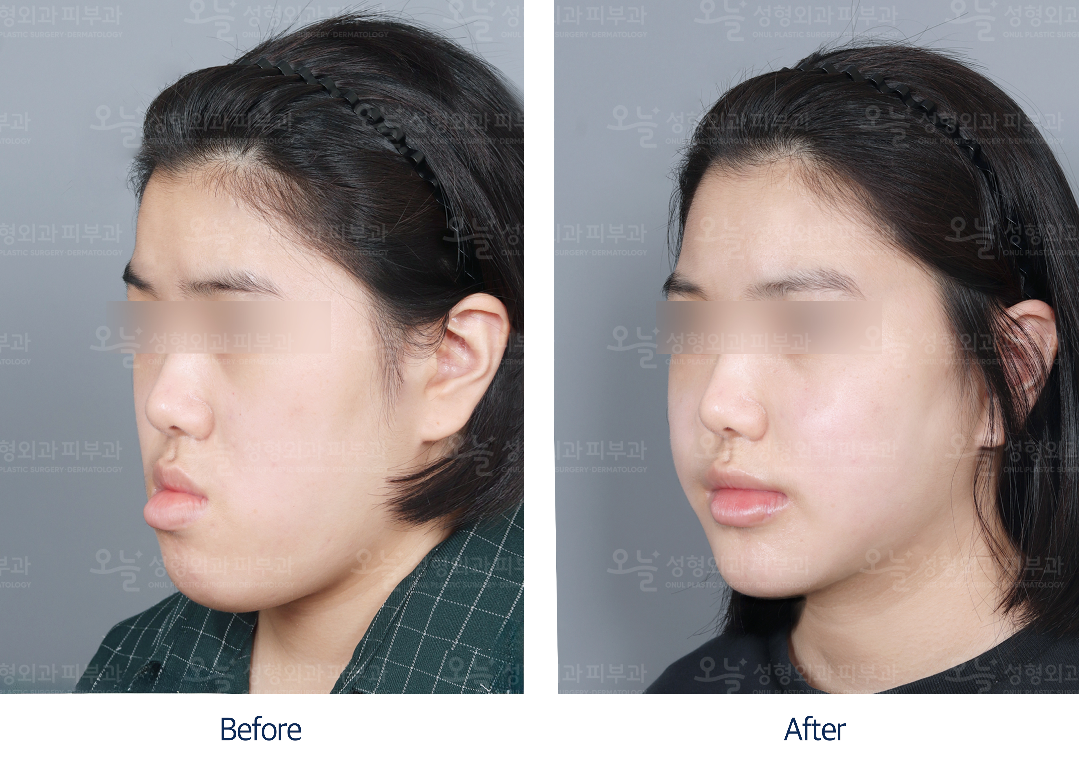 오늘성형외과 전후사진