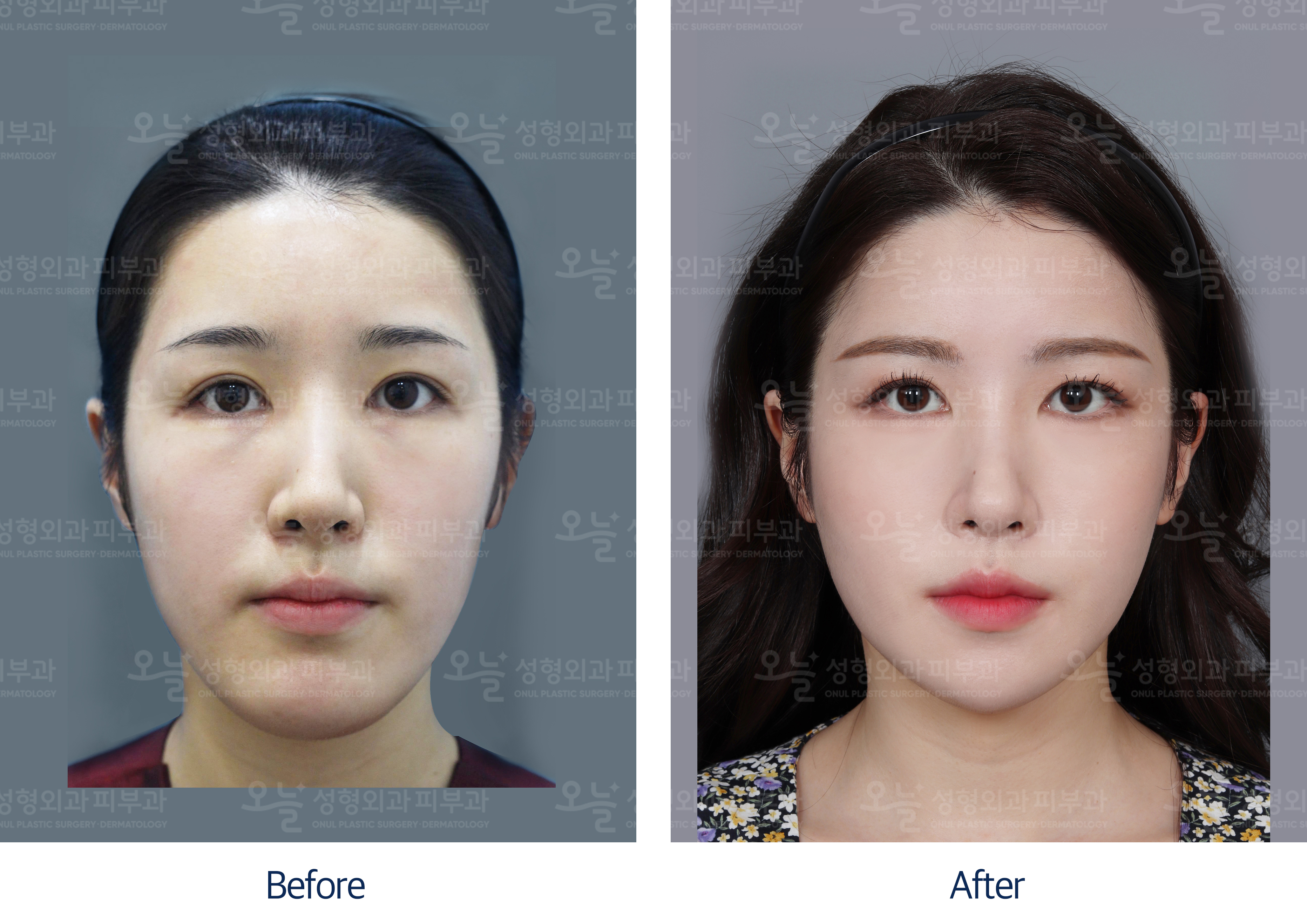 오늘성형외과 전후사진
