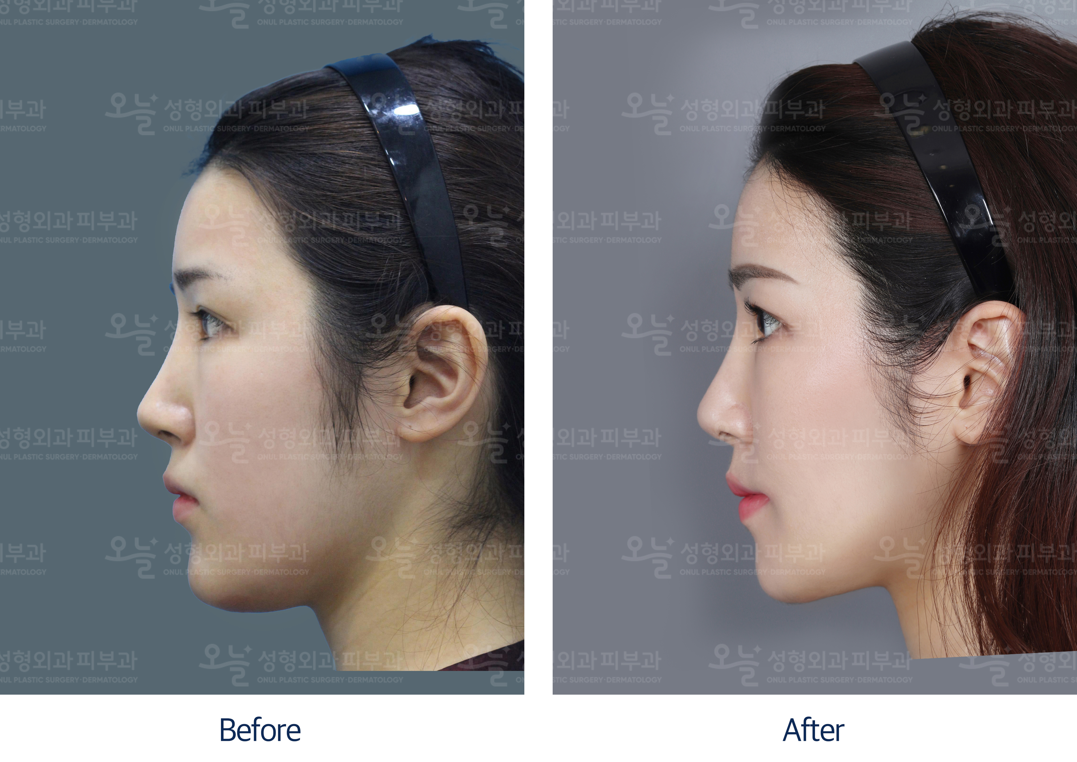 오늘성형외과 전후사진