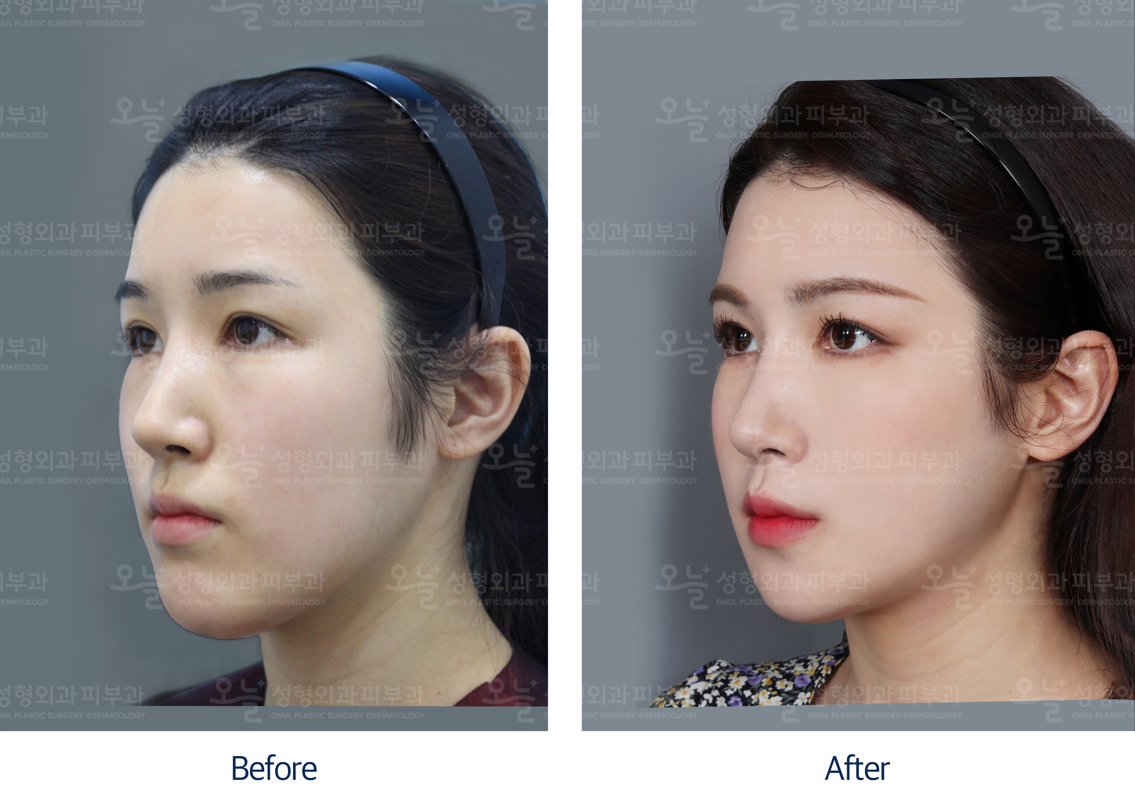 오늘성형외과 전후사진