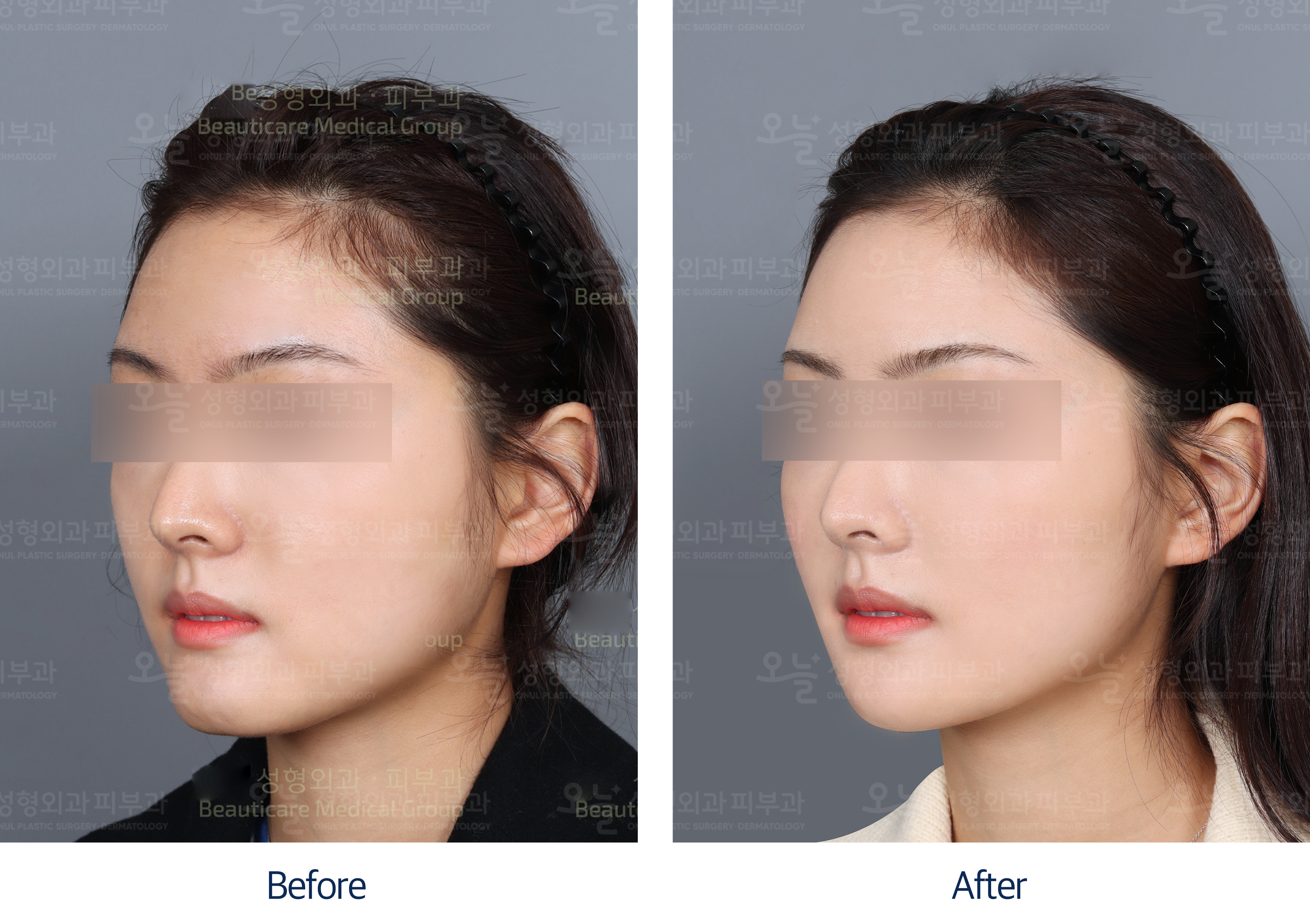 오늘성형외과 전후사진