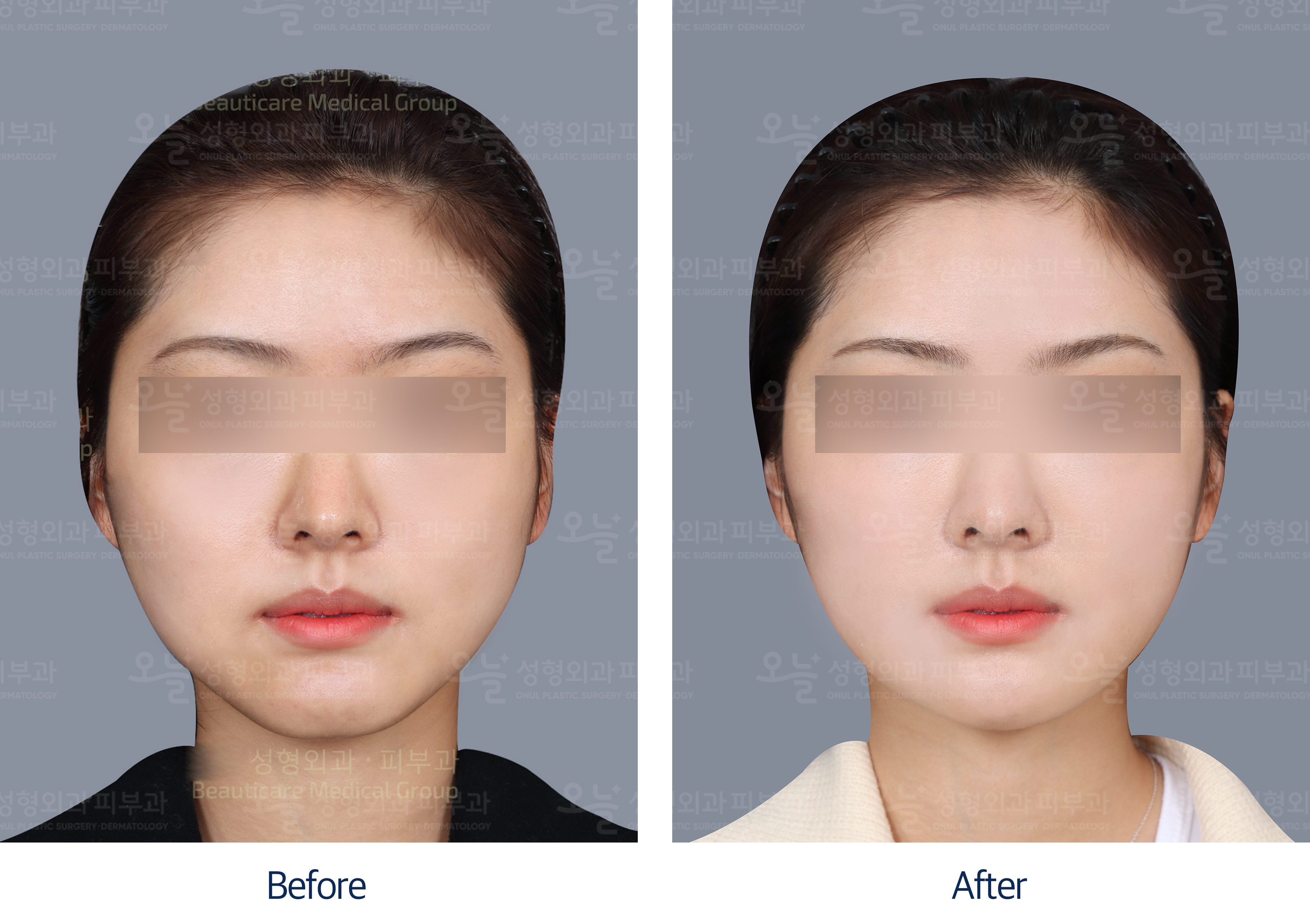 오늘성형외과 전후사진