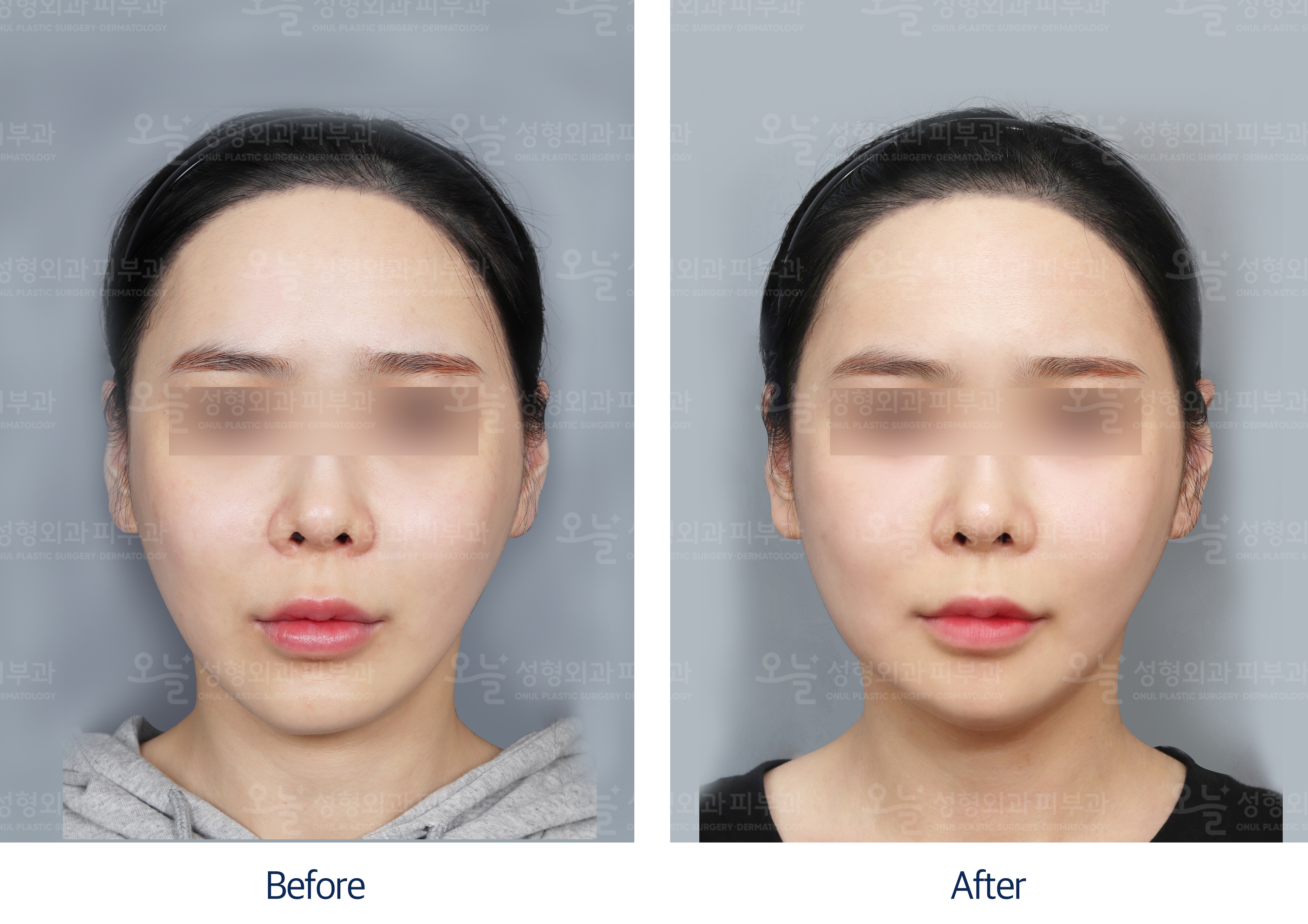 오늘성형외과 전후사진