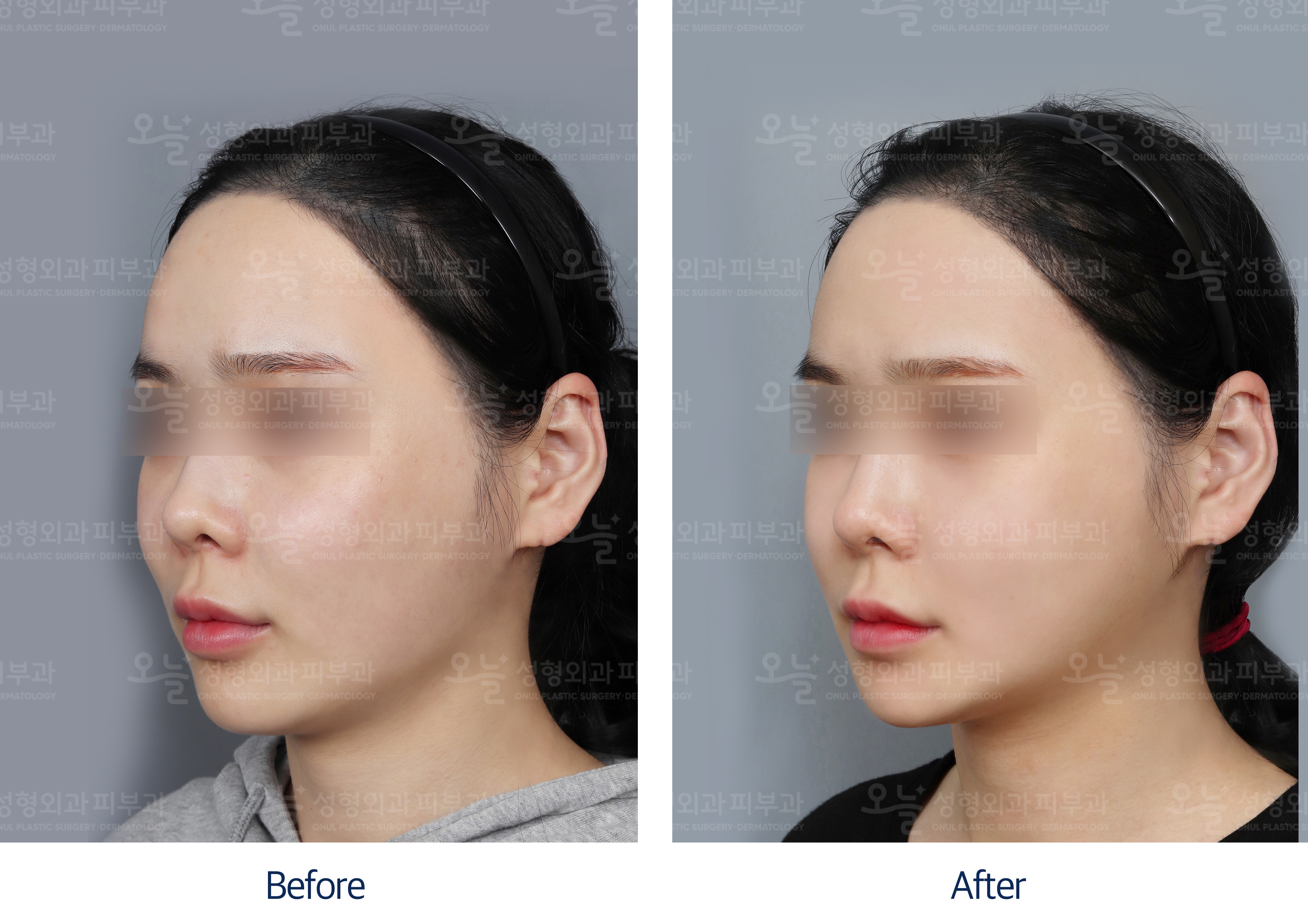 오늘성형외과 전후사진