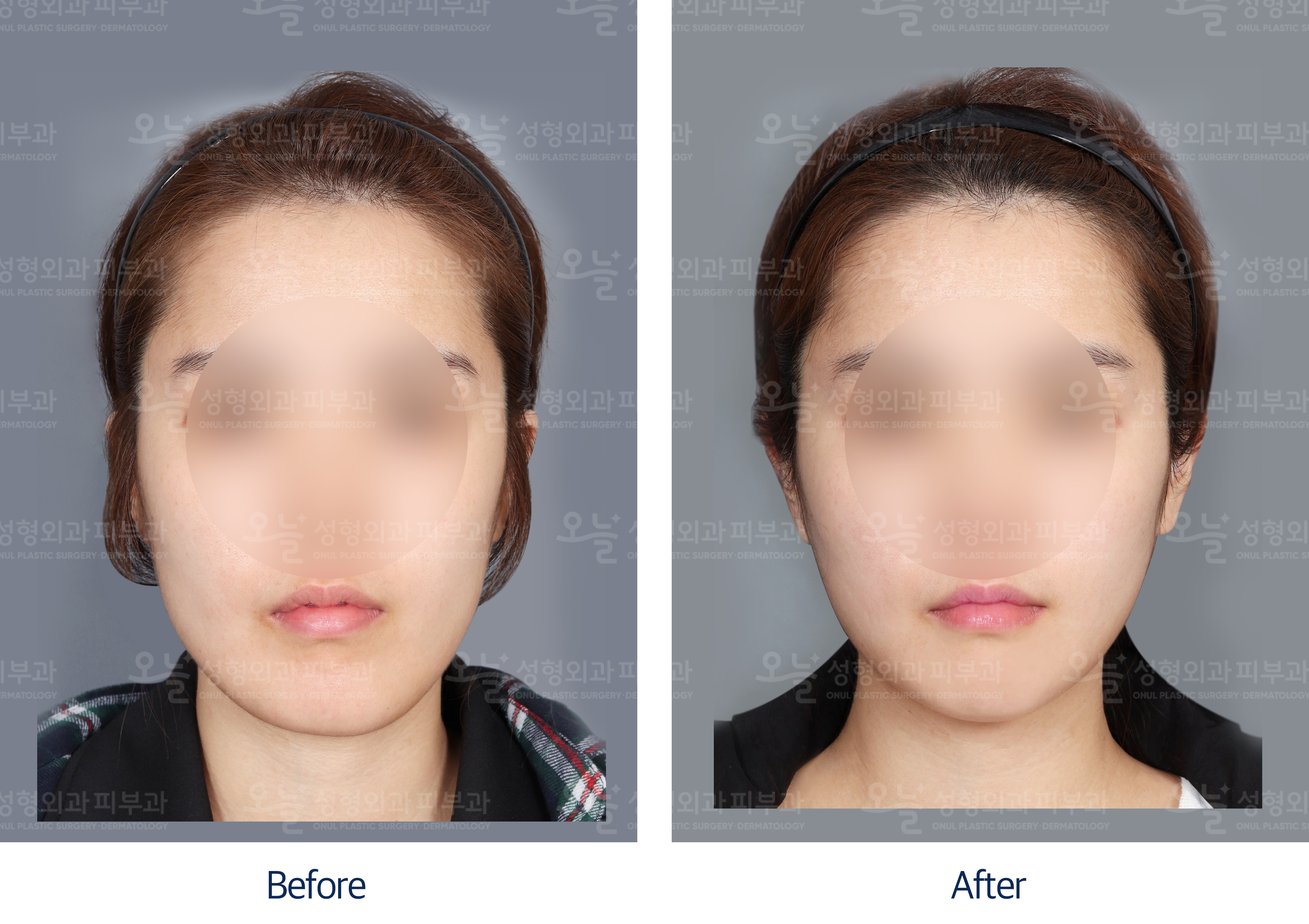 오늘성형외과 전후사진