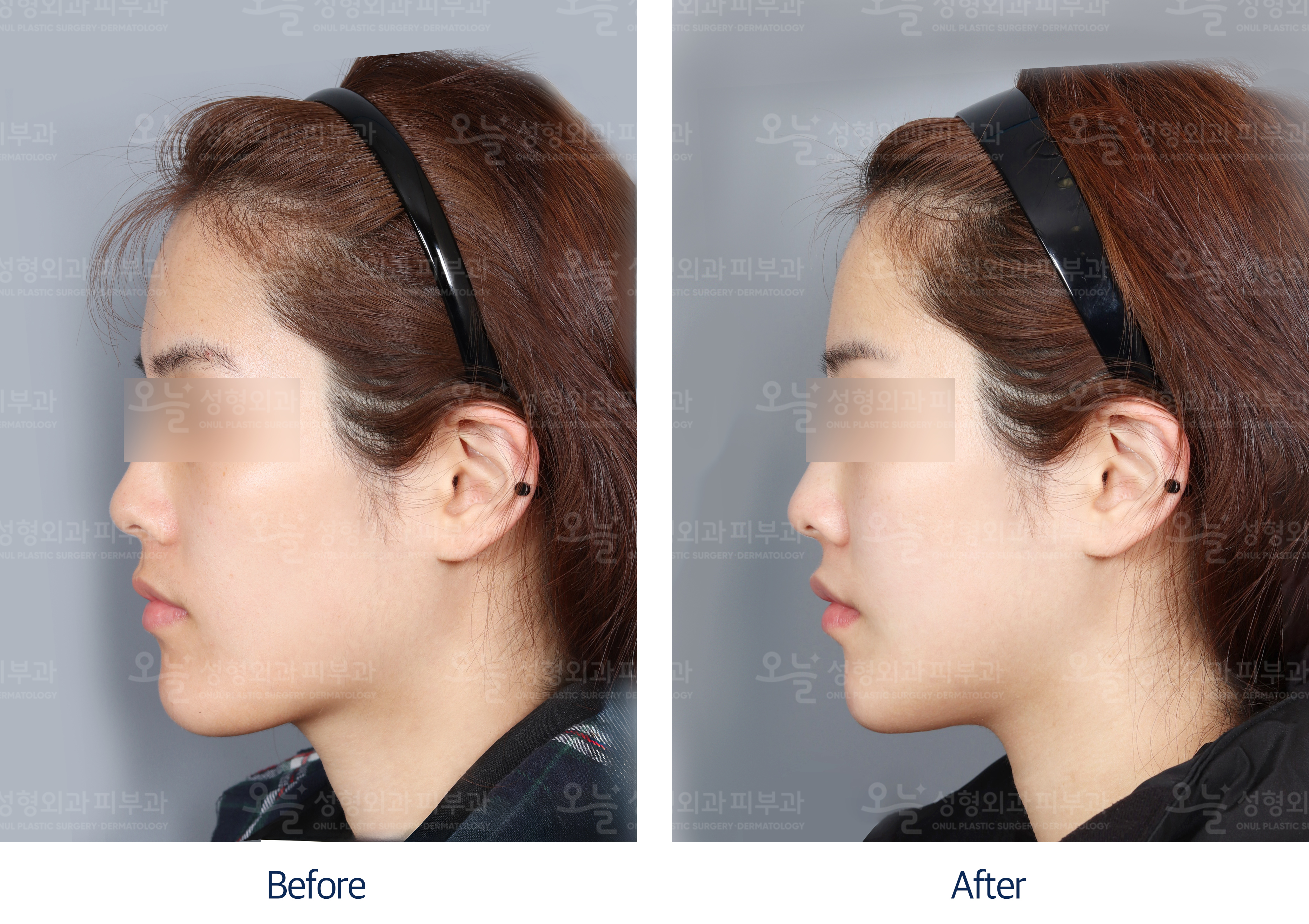 오늘성형외과 전후사진