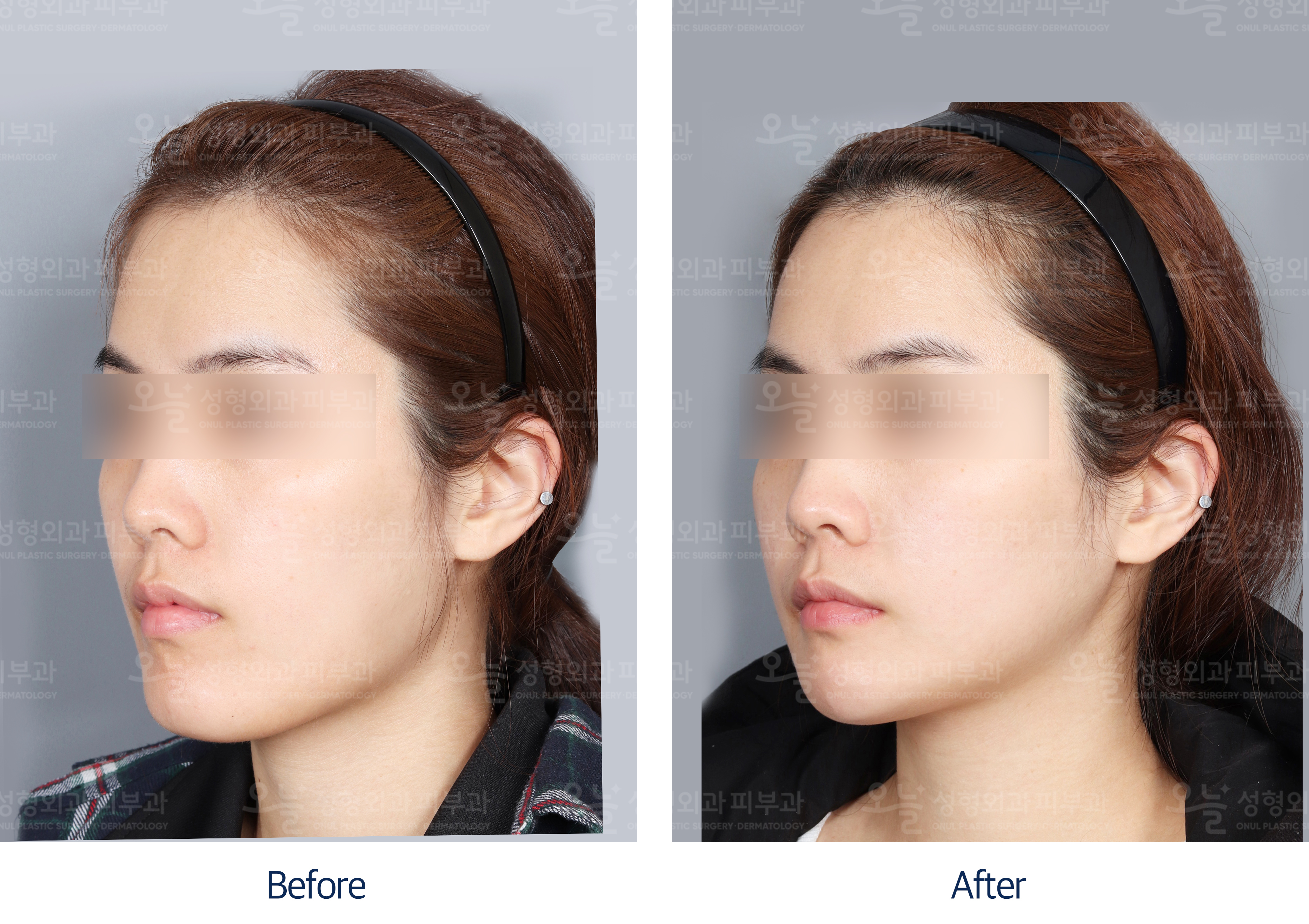 오늘성형외과 전후사진