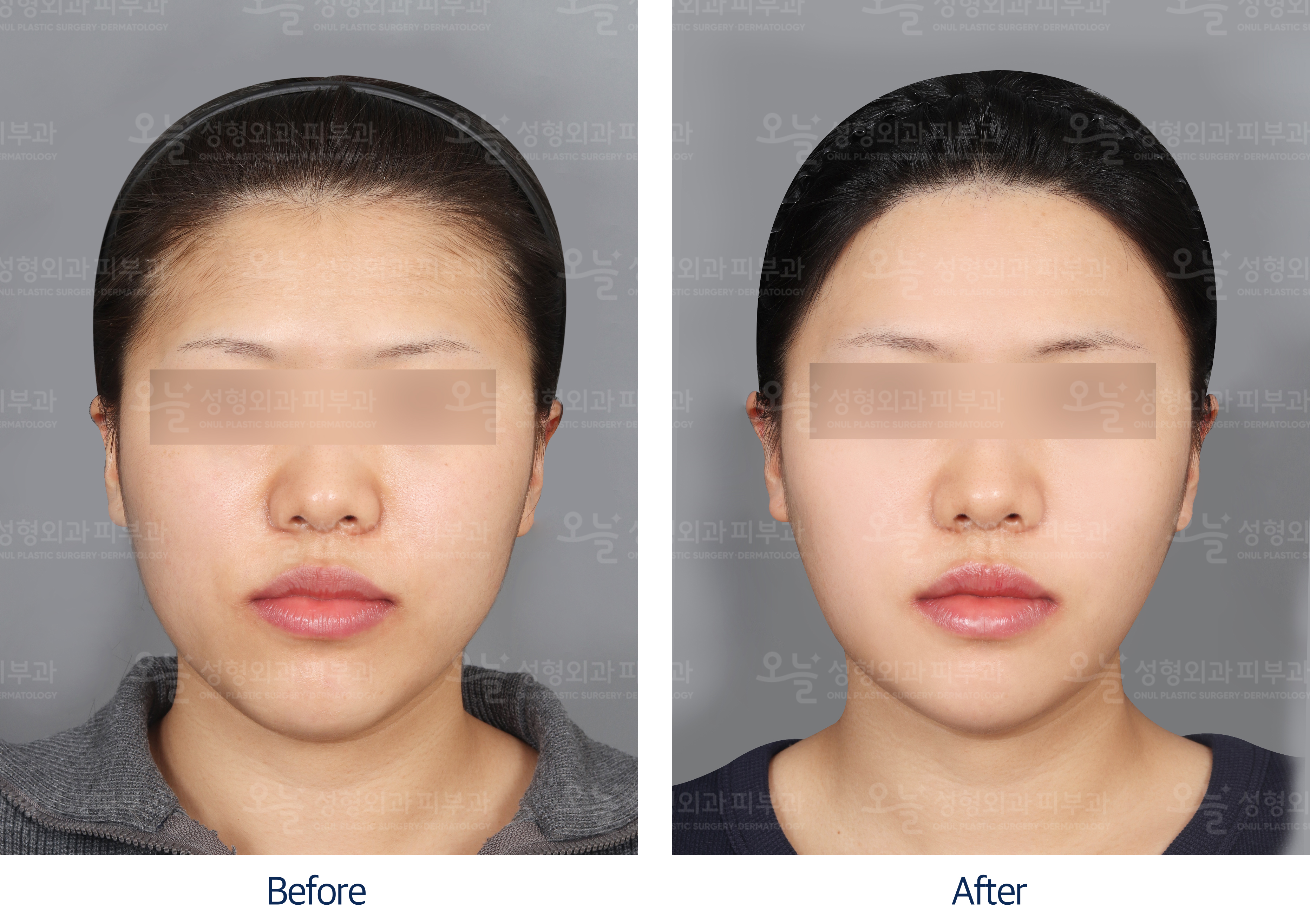 오늘성형외과 전후사진