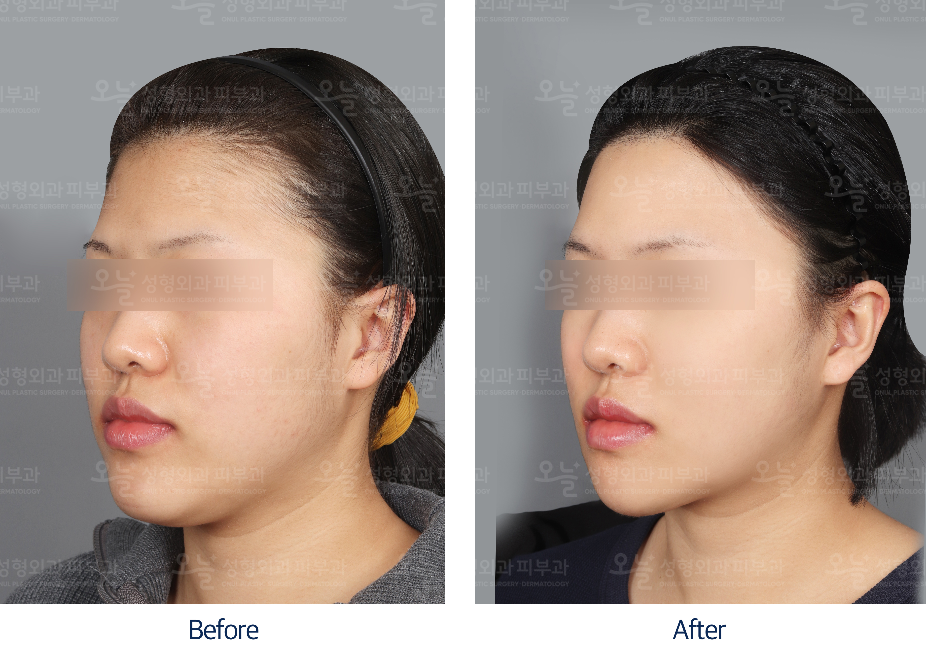 오늘성형외과 전후사진