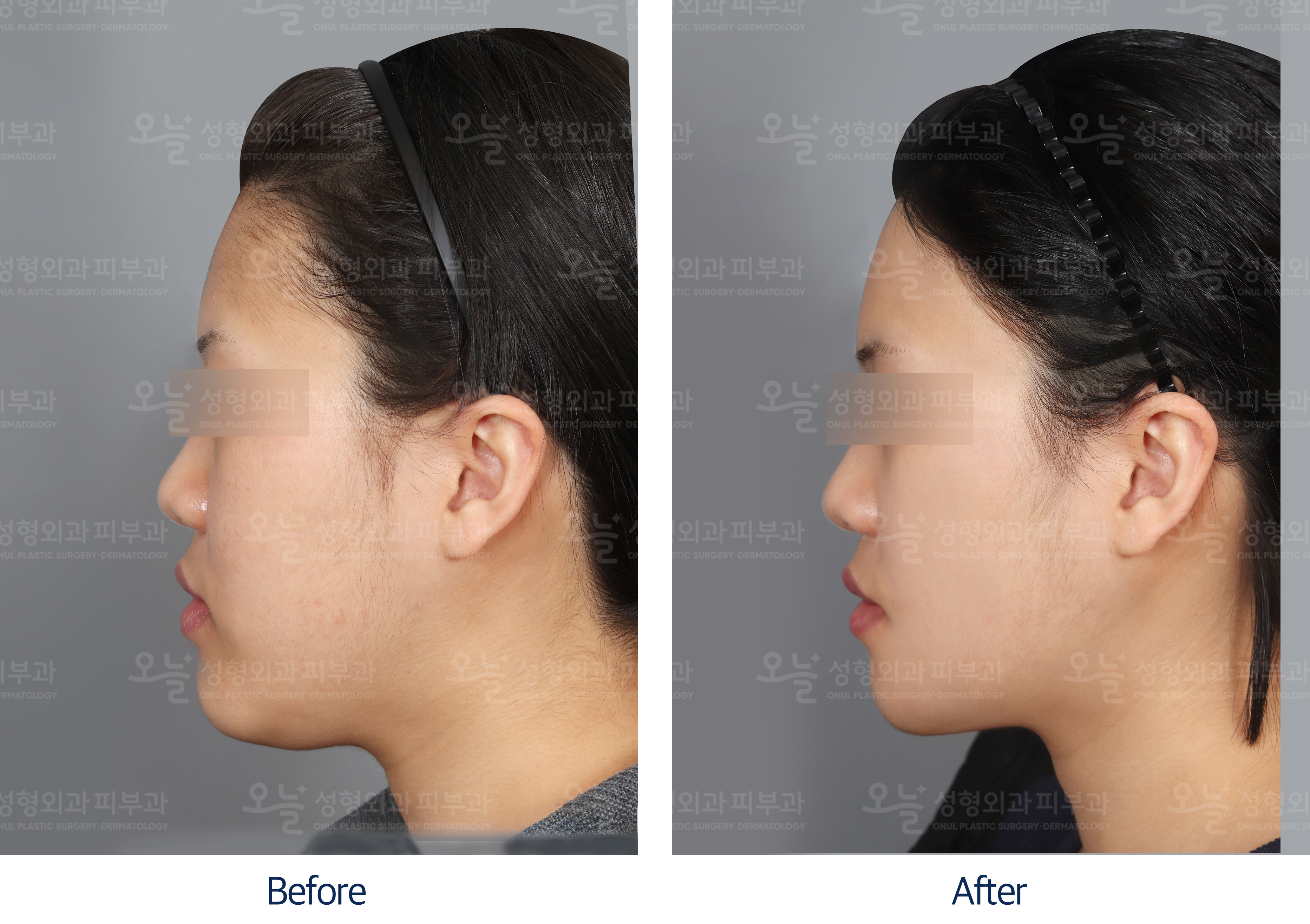 오늘성형외과 전후사진