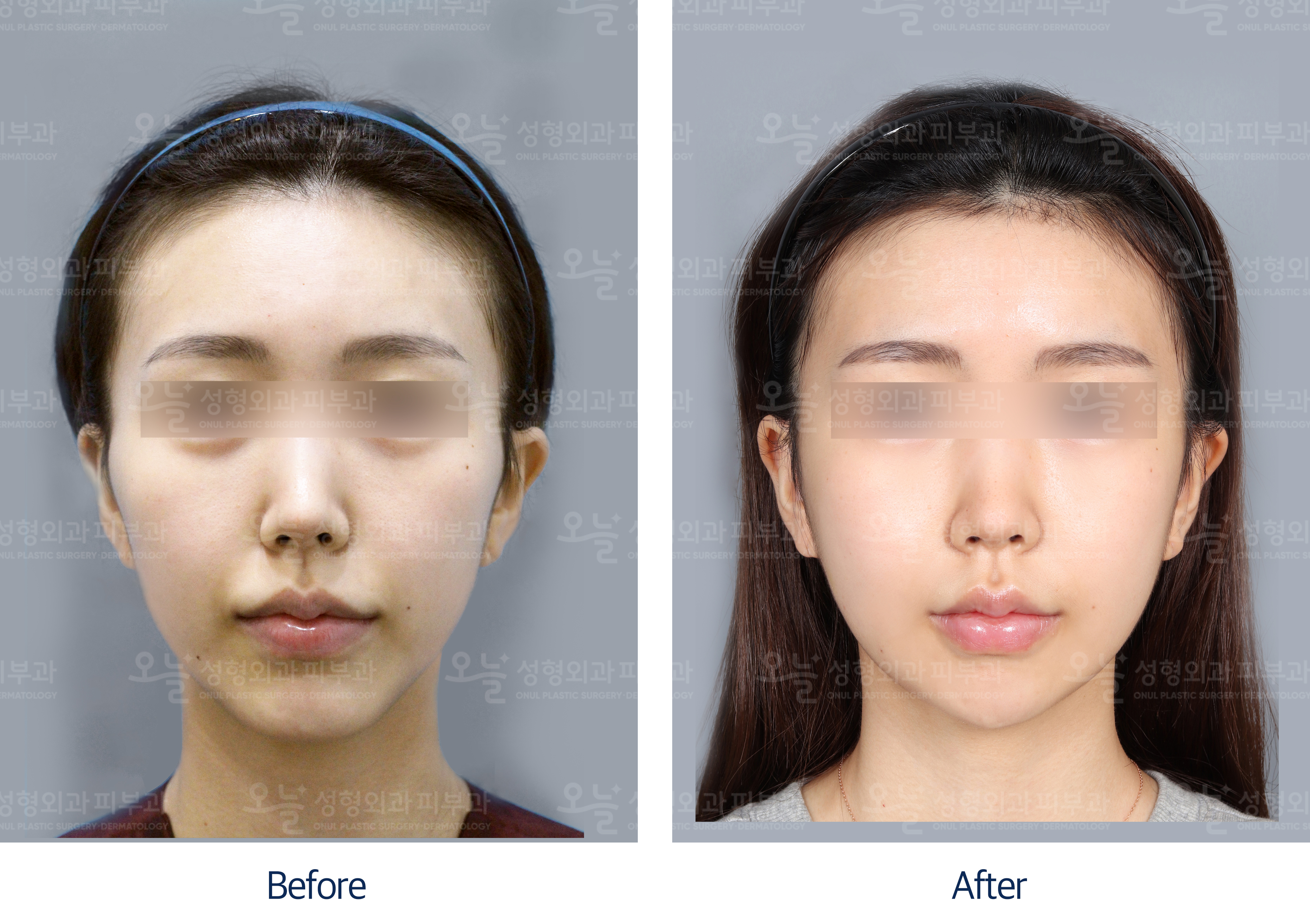 오늘성형외과 전후사진