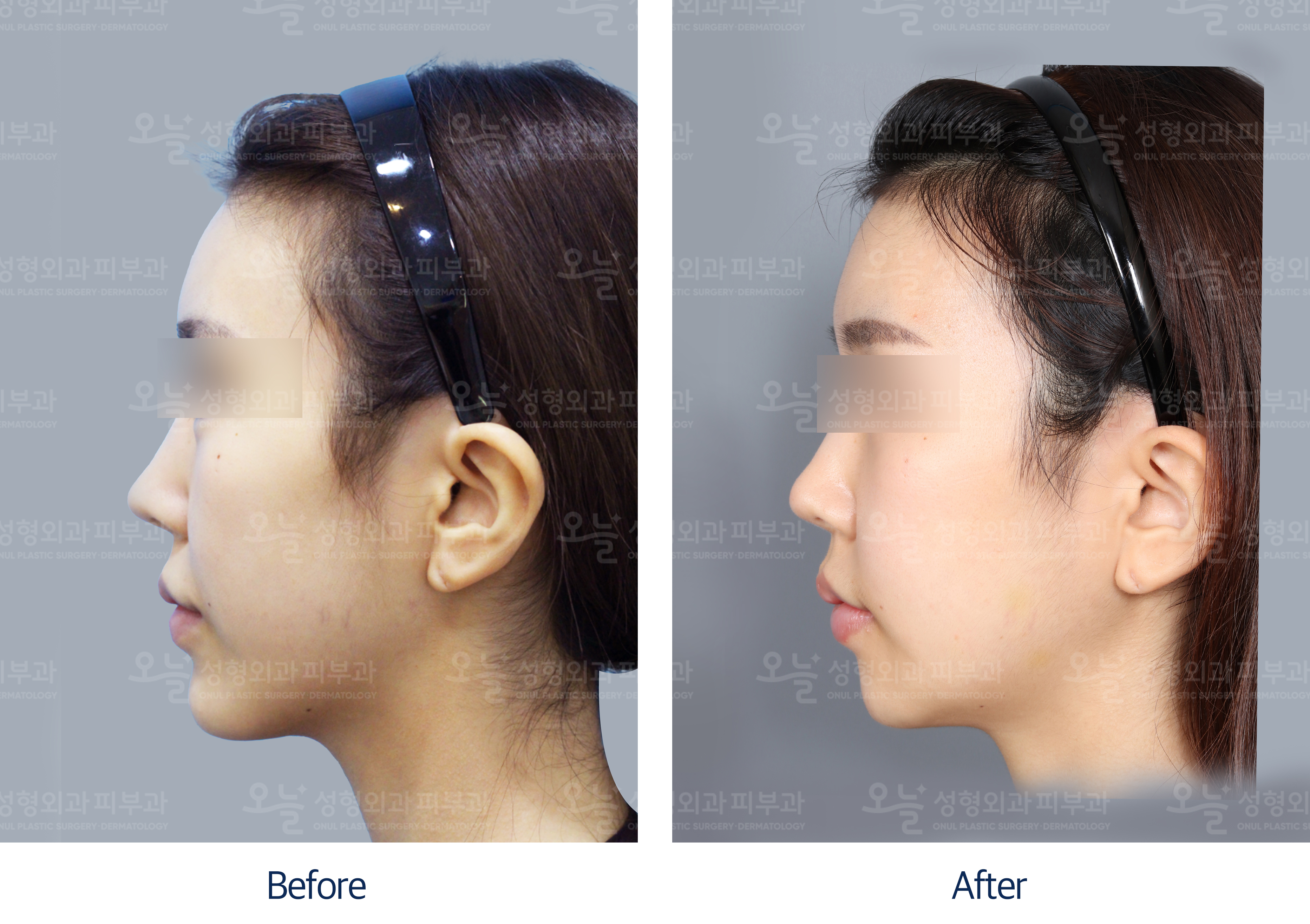 오늘성형외과 전후사진