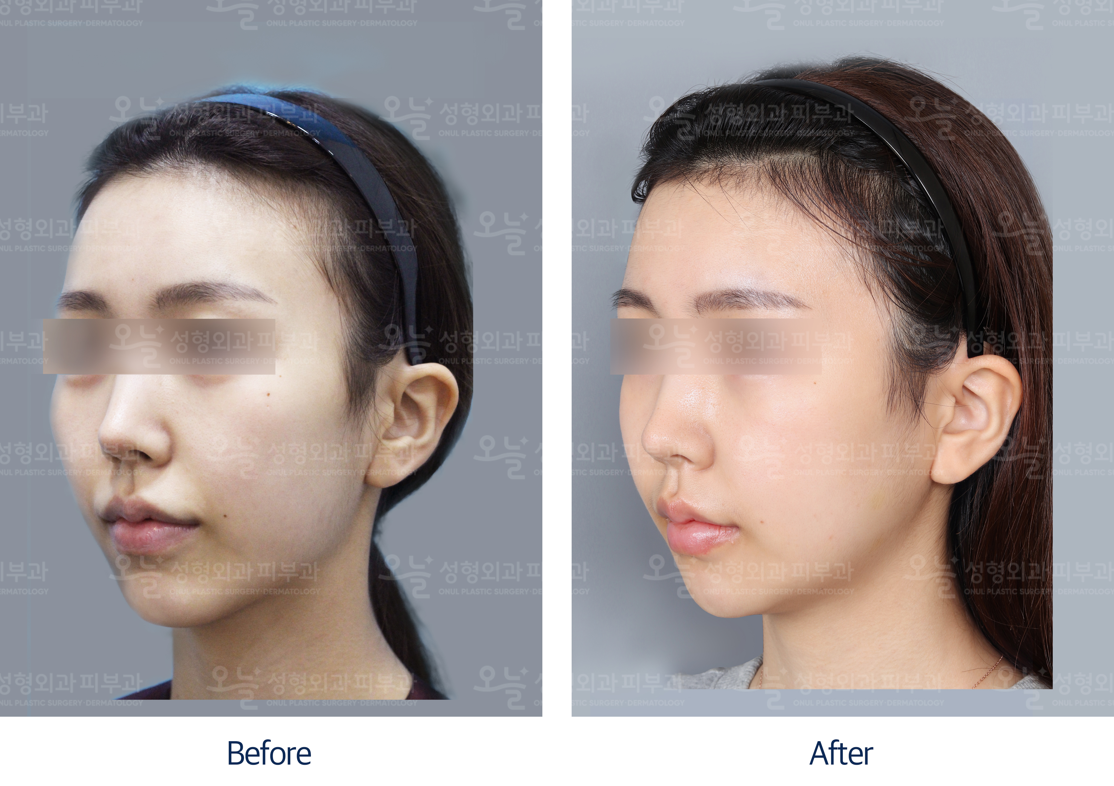 오늘성형외과 전후사진