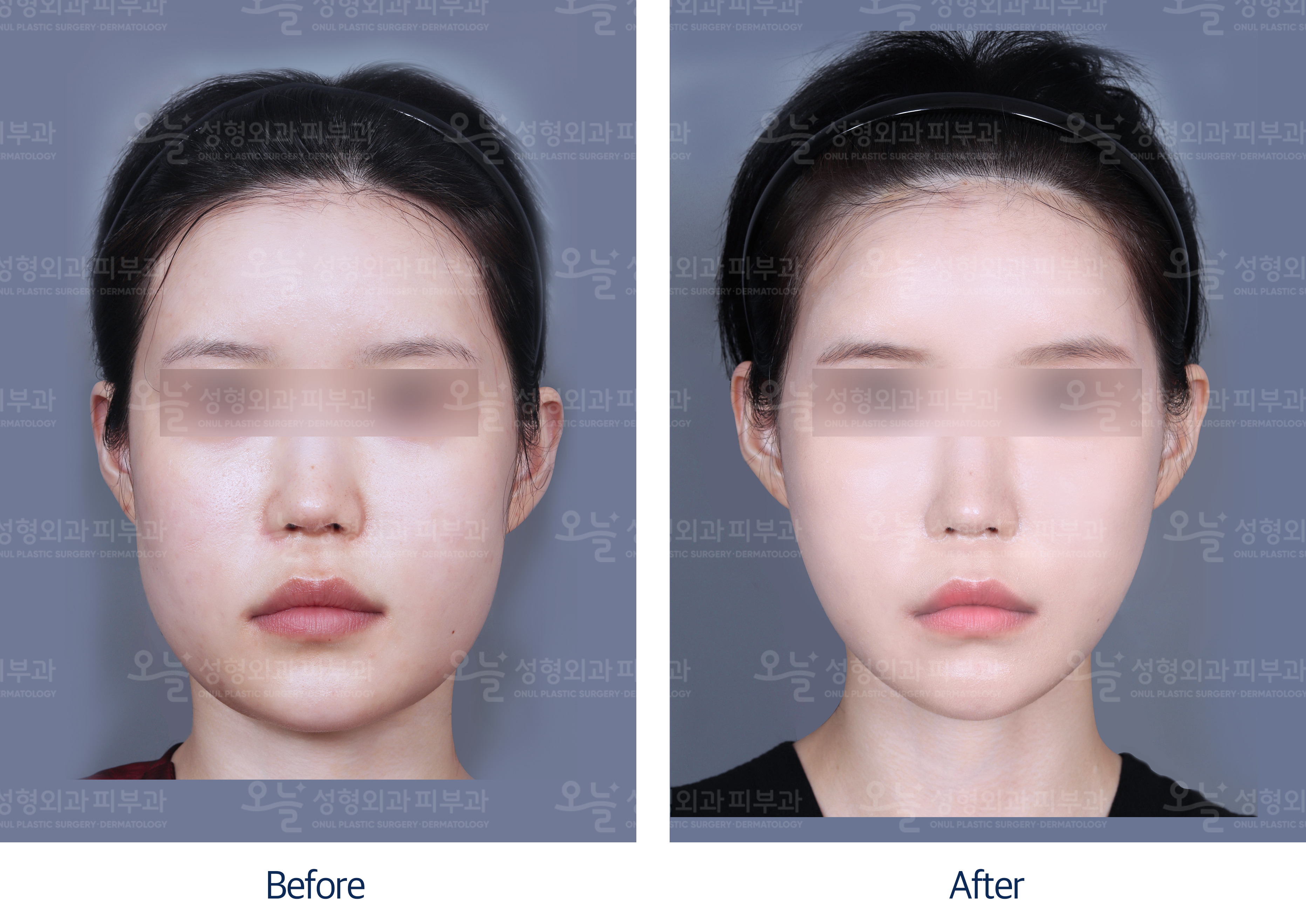 오늘성형외과 전후사진