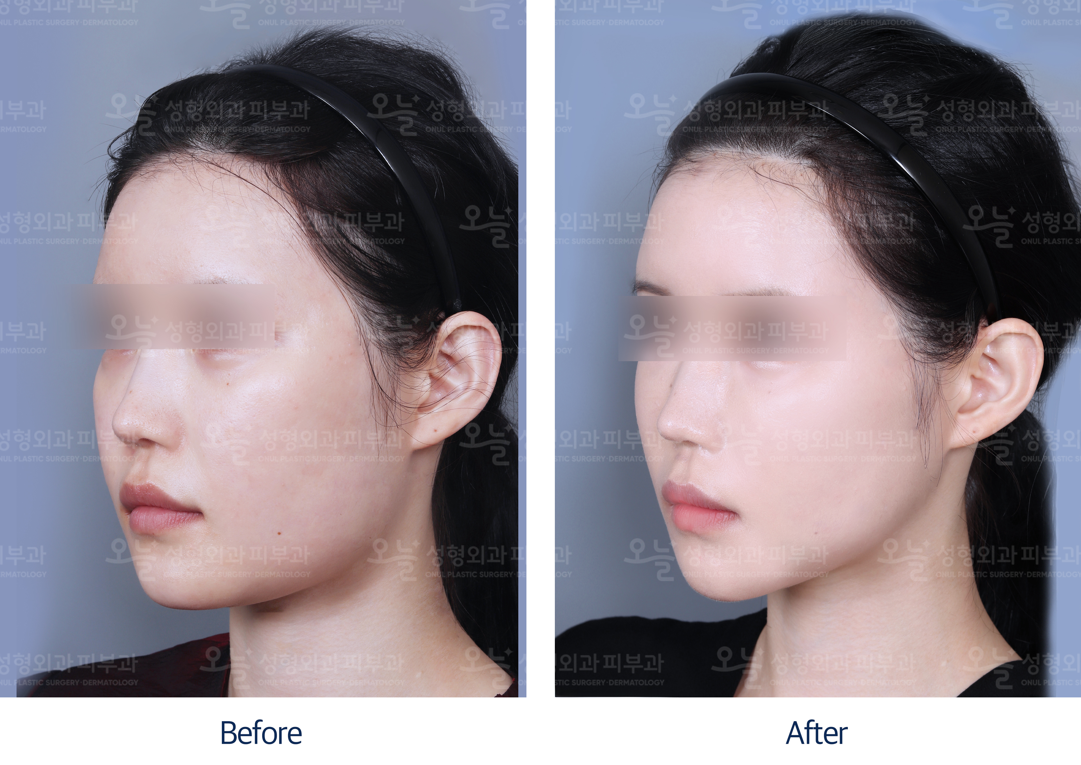 오늘성형외과 전후사진