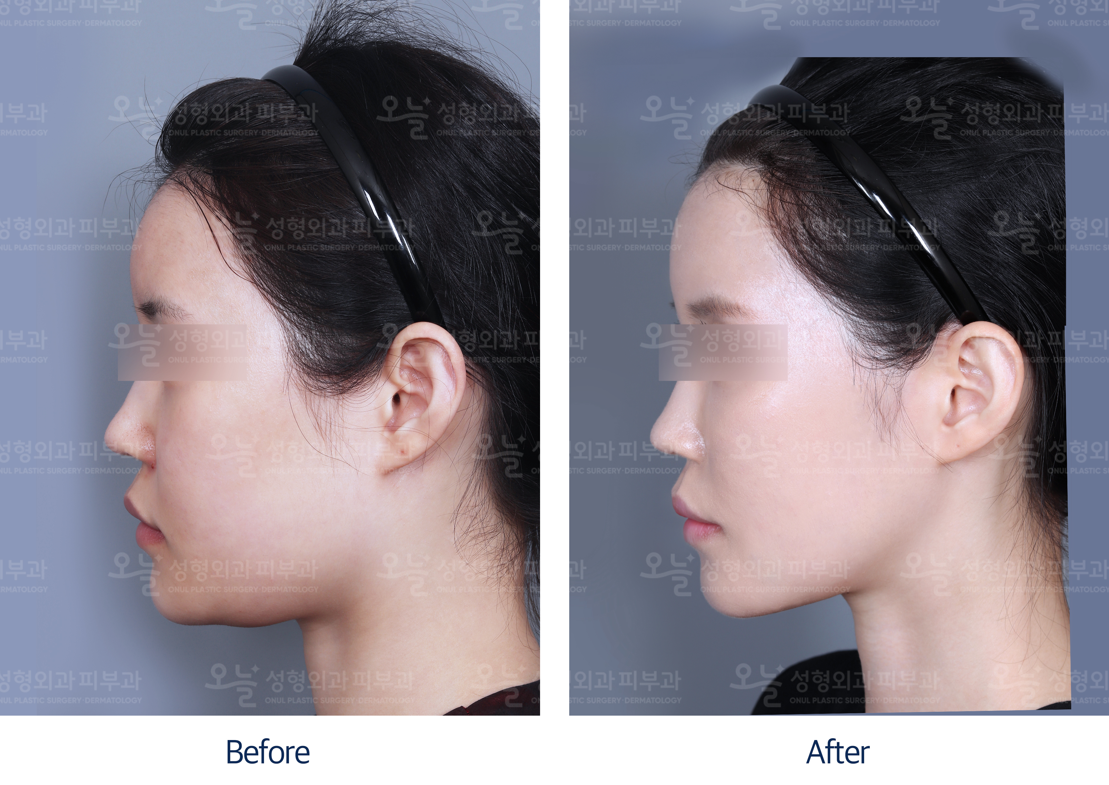 오늘성형외과 전후사진