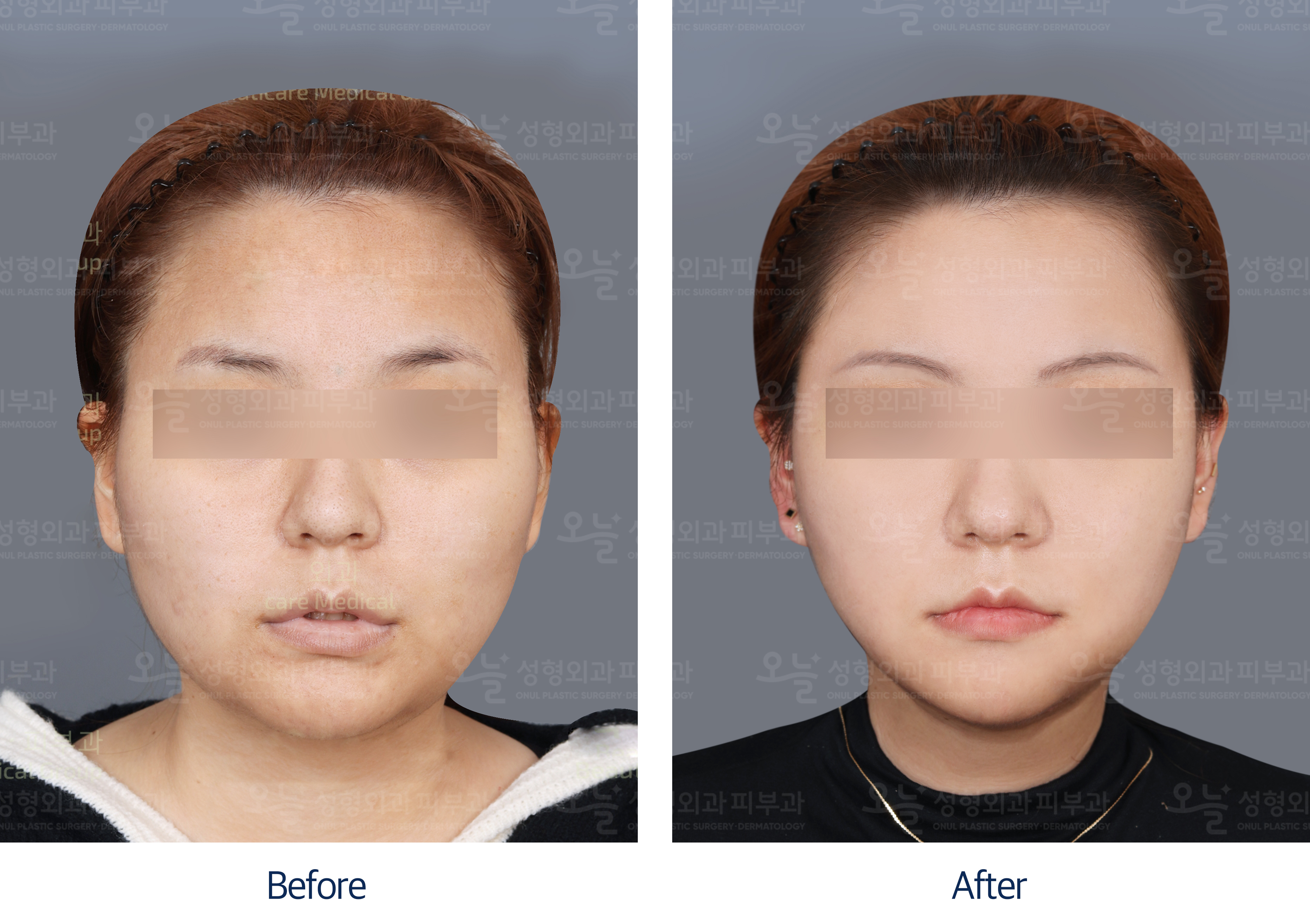 오늘성형외과 전후사진
