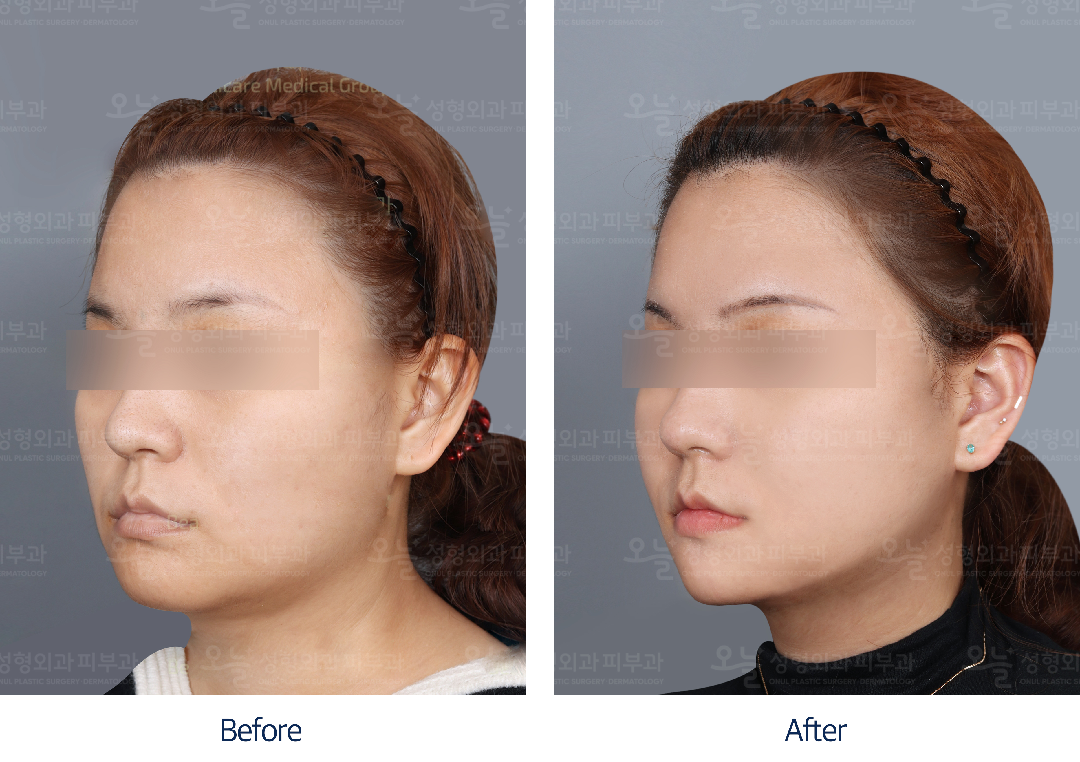 오늘성형외과 전후사진