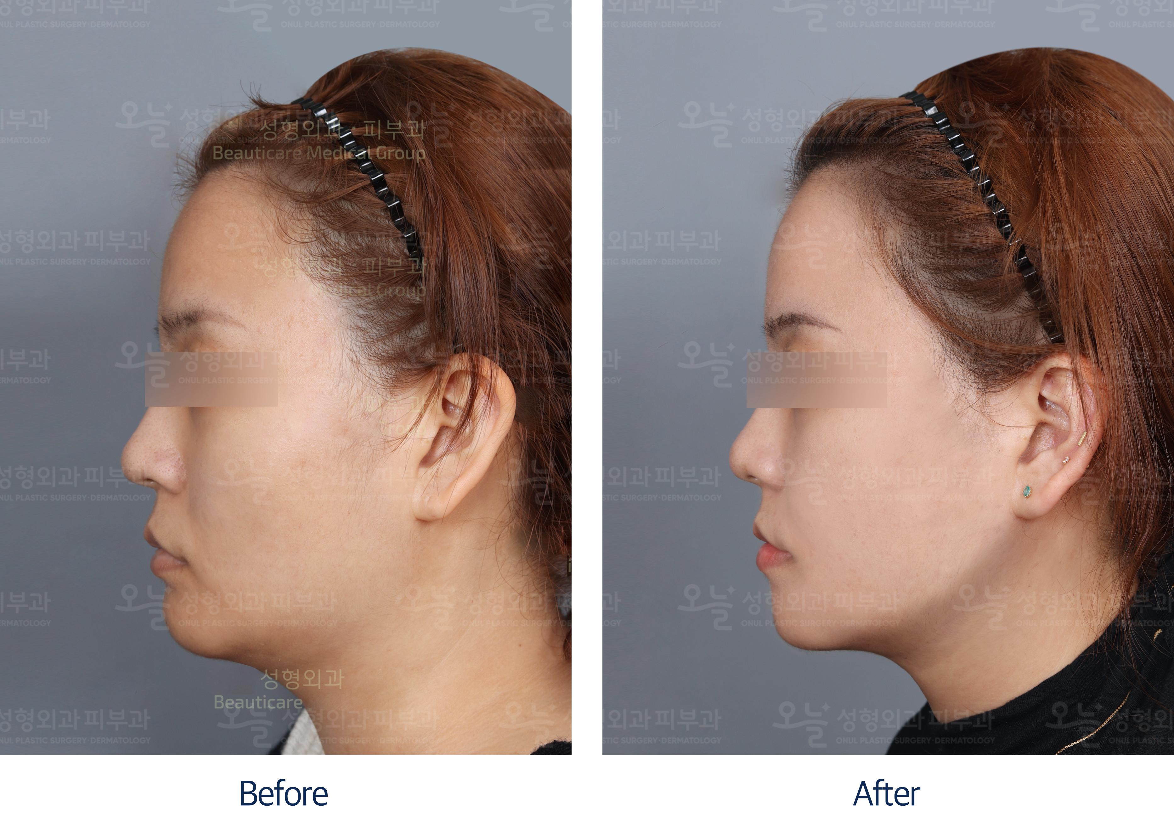 오늘성형외과 전후사진