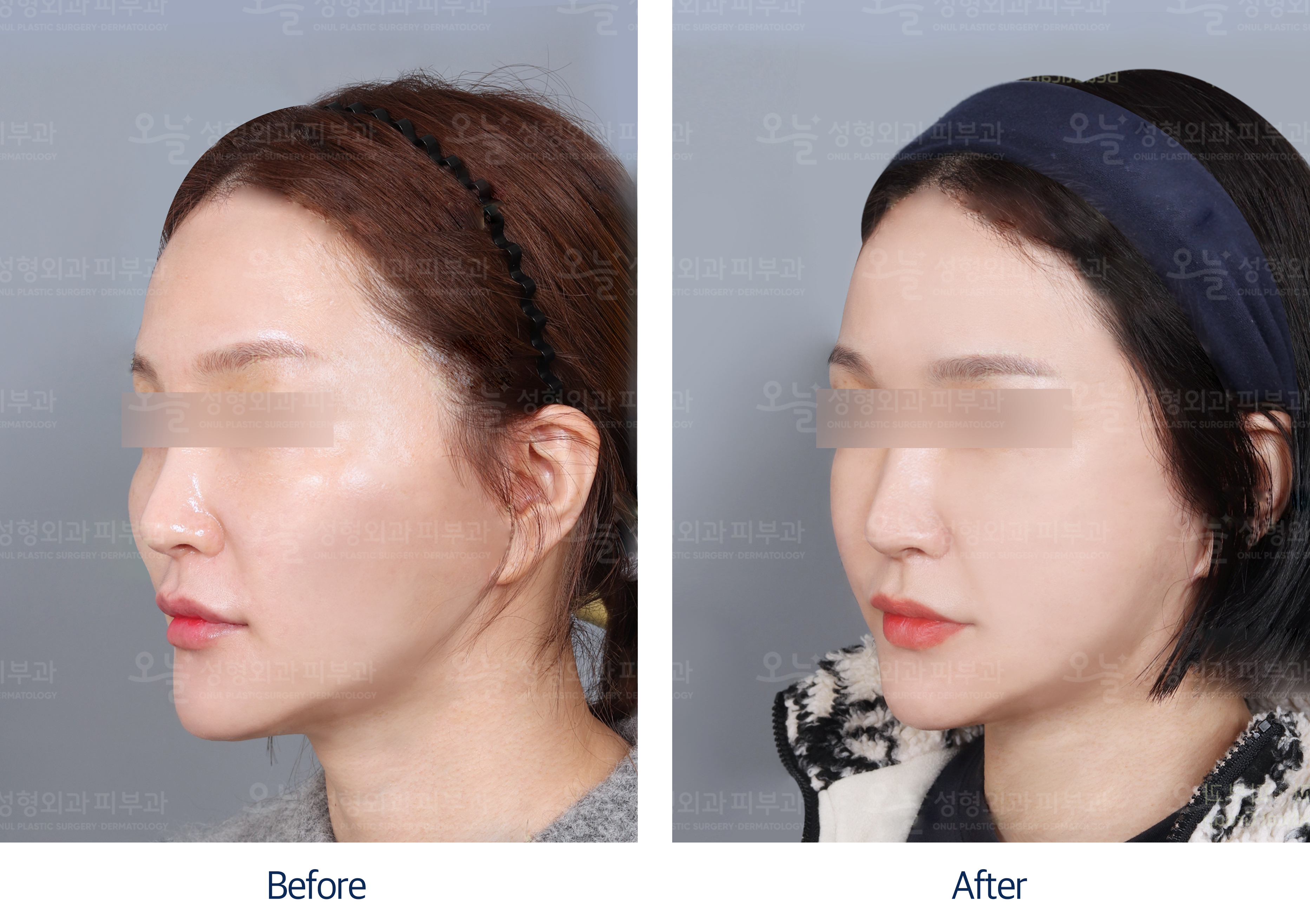 오늘성형외과 전후사진