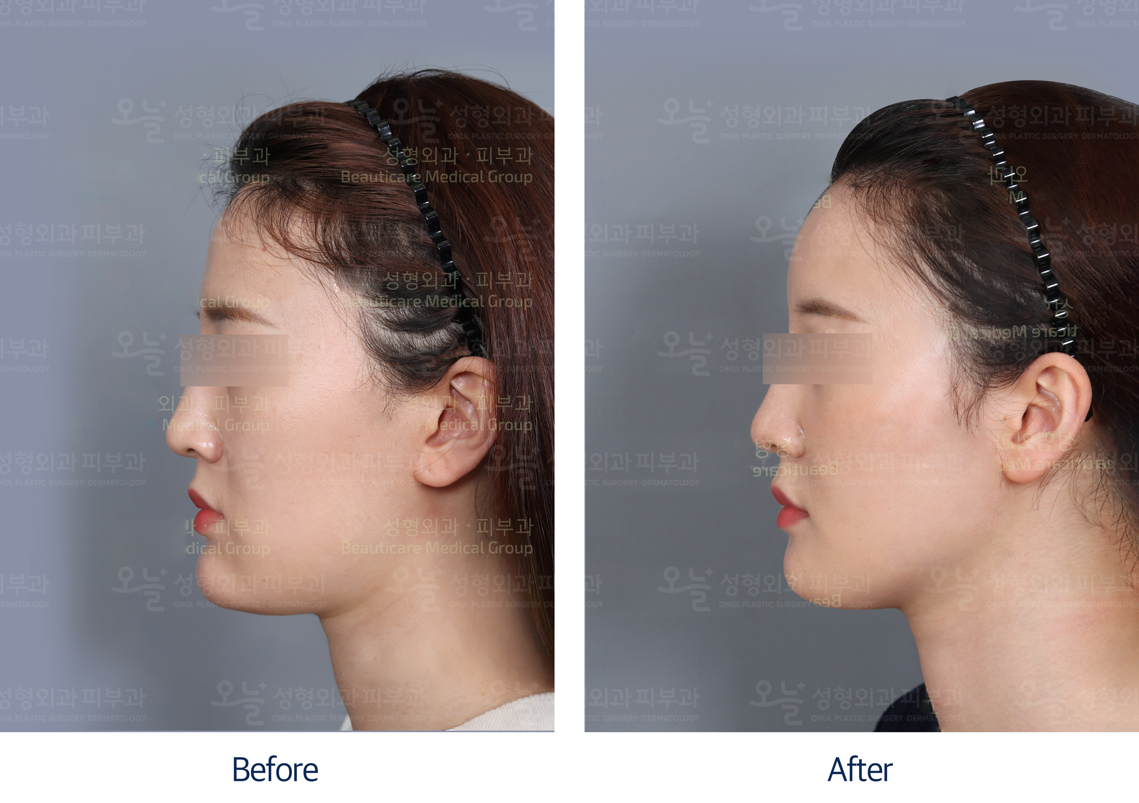 오늘성형외과 전후사진