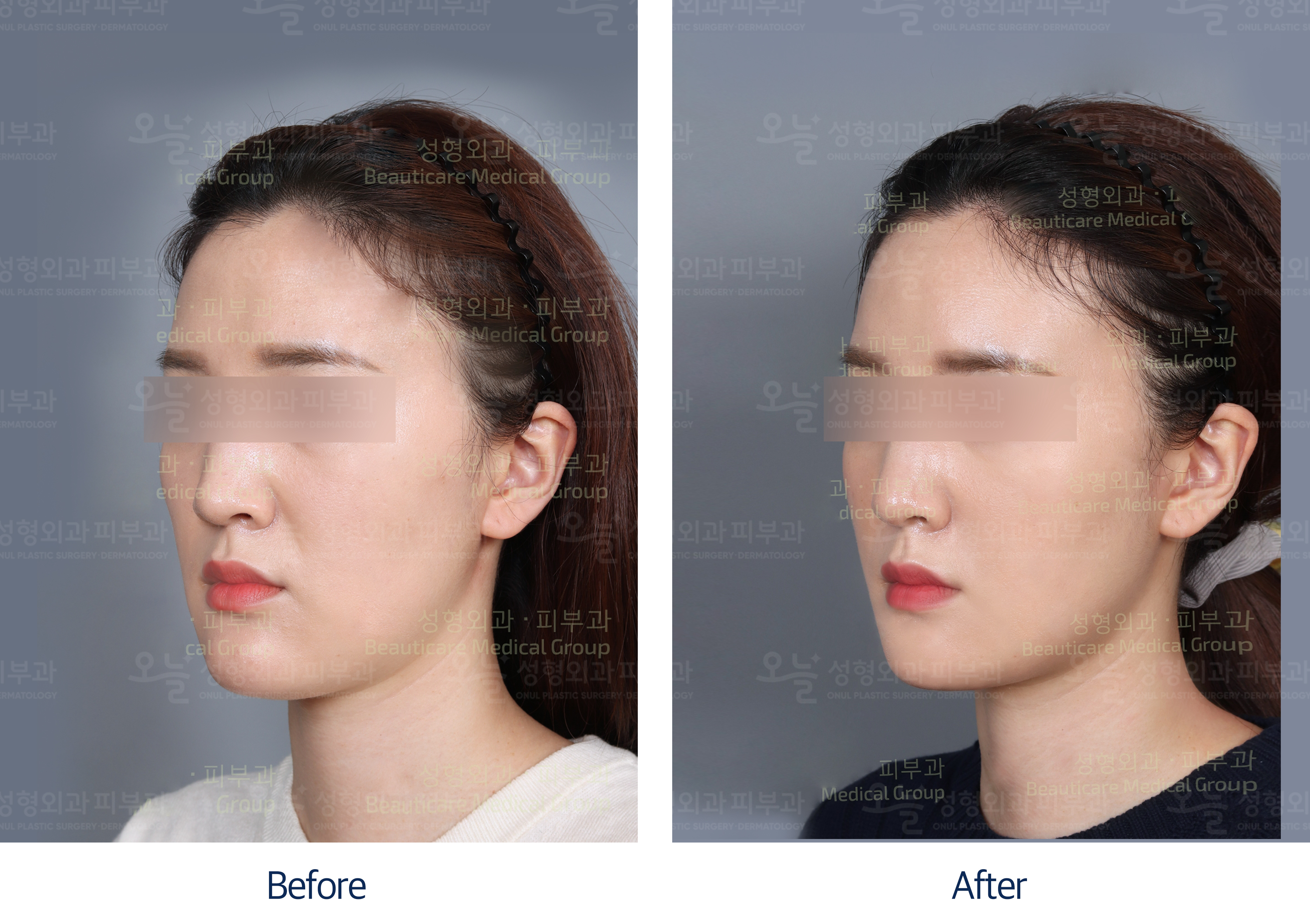 오늘성형외과 전후사진
