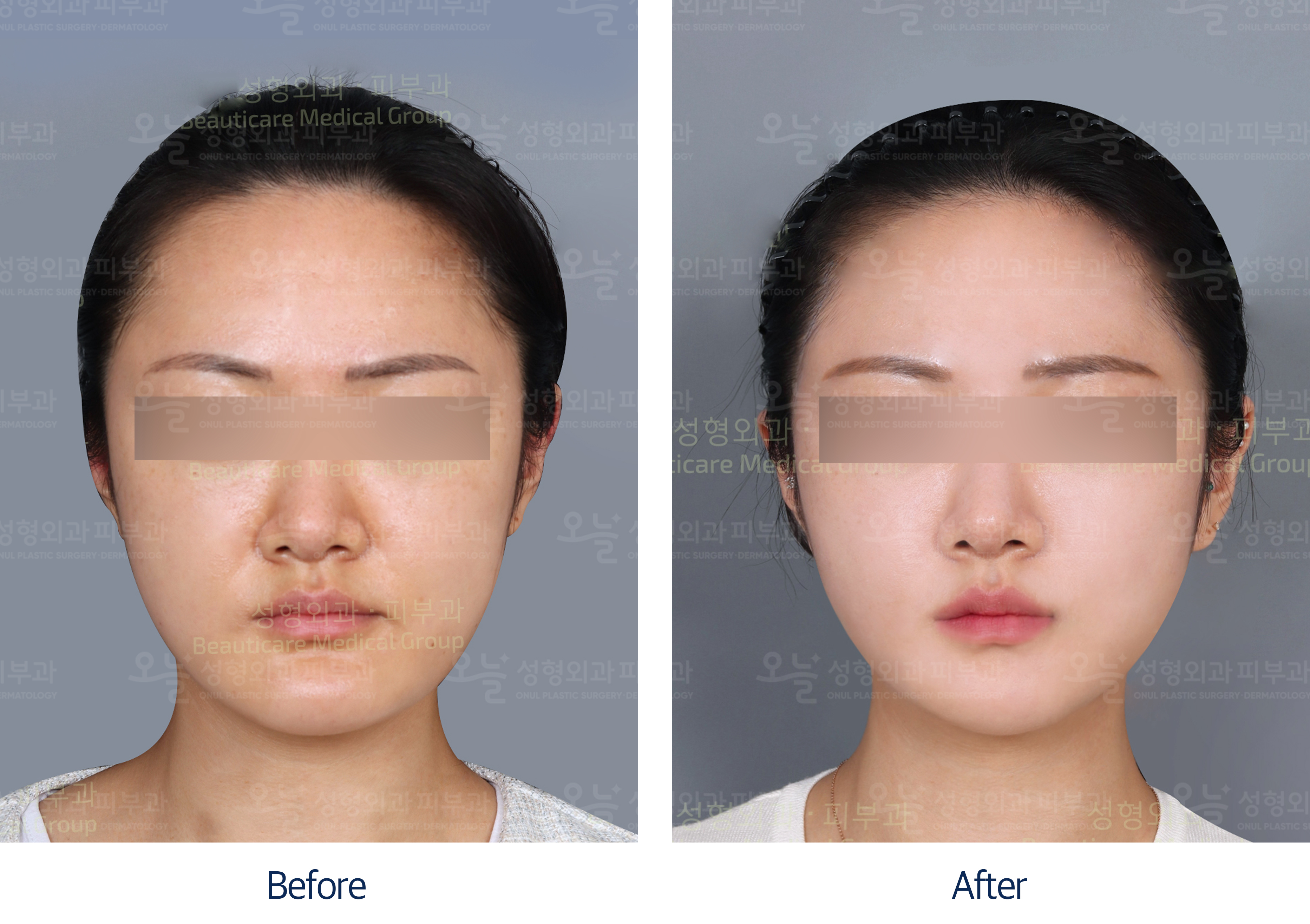 오늘성형외과 전후사진