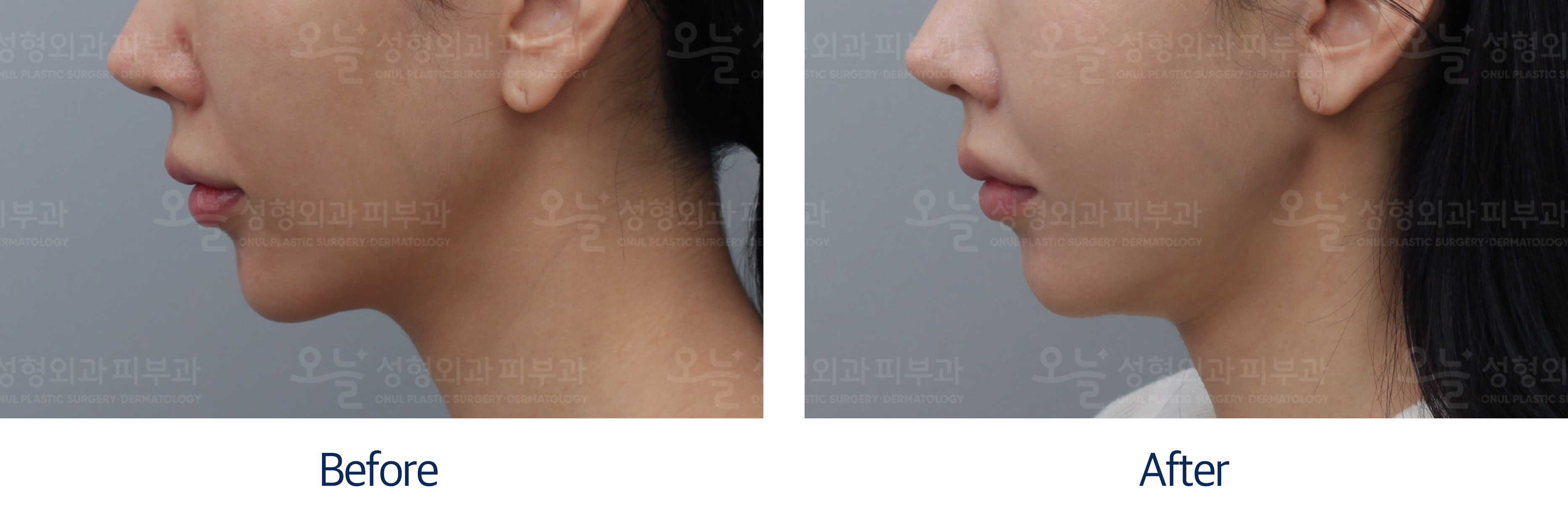 오늘성형외과 전후사진