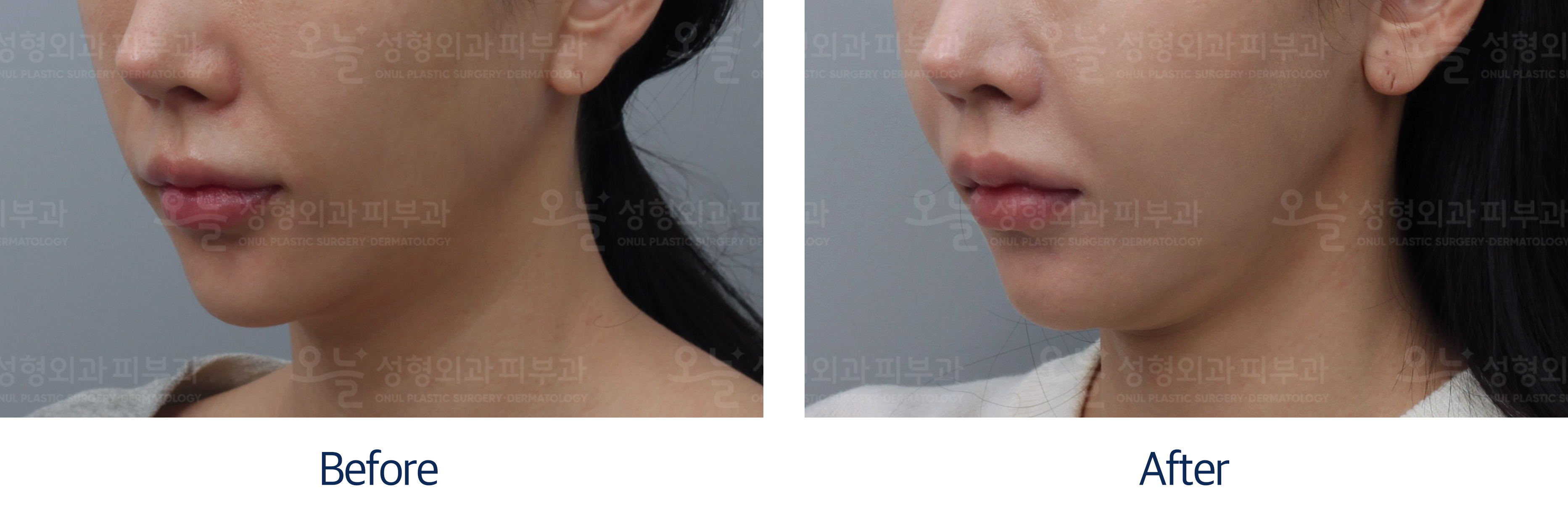 오늘성형외과 전후사진