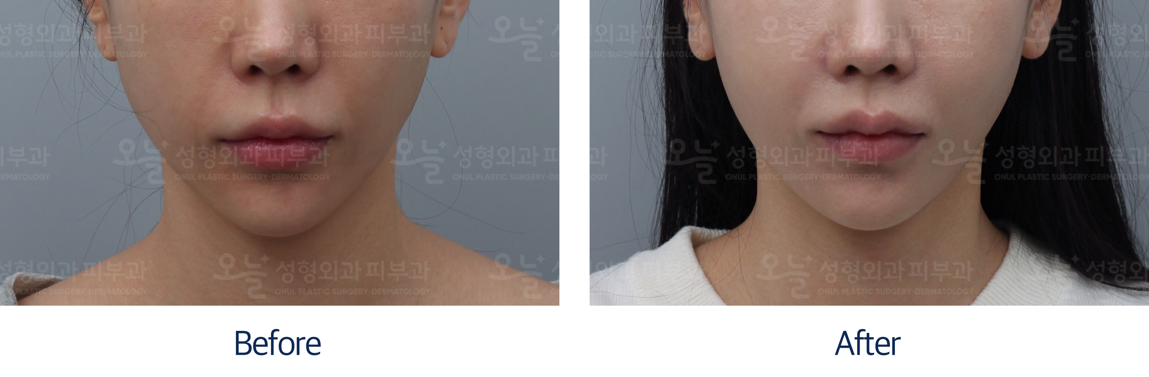 오늘성형외과 전후사진