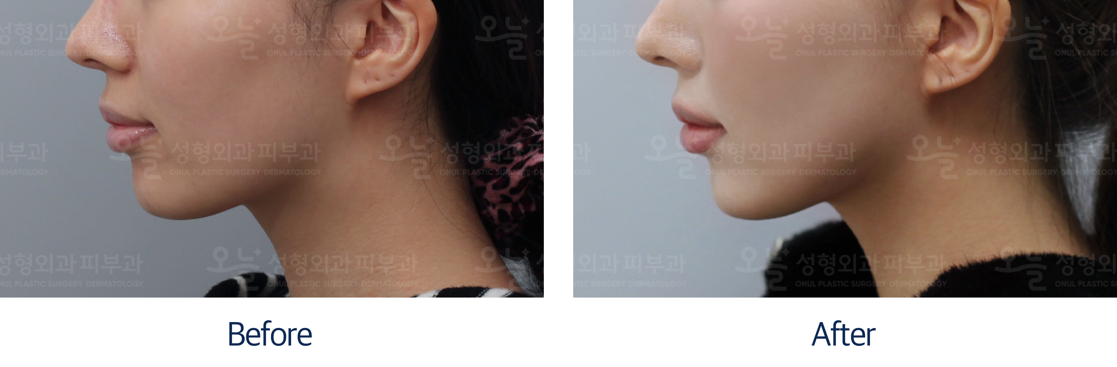 오늘성형외과 전후사진