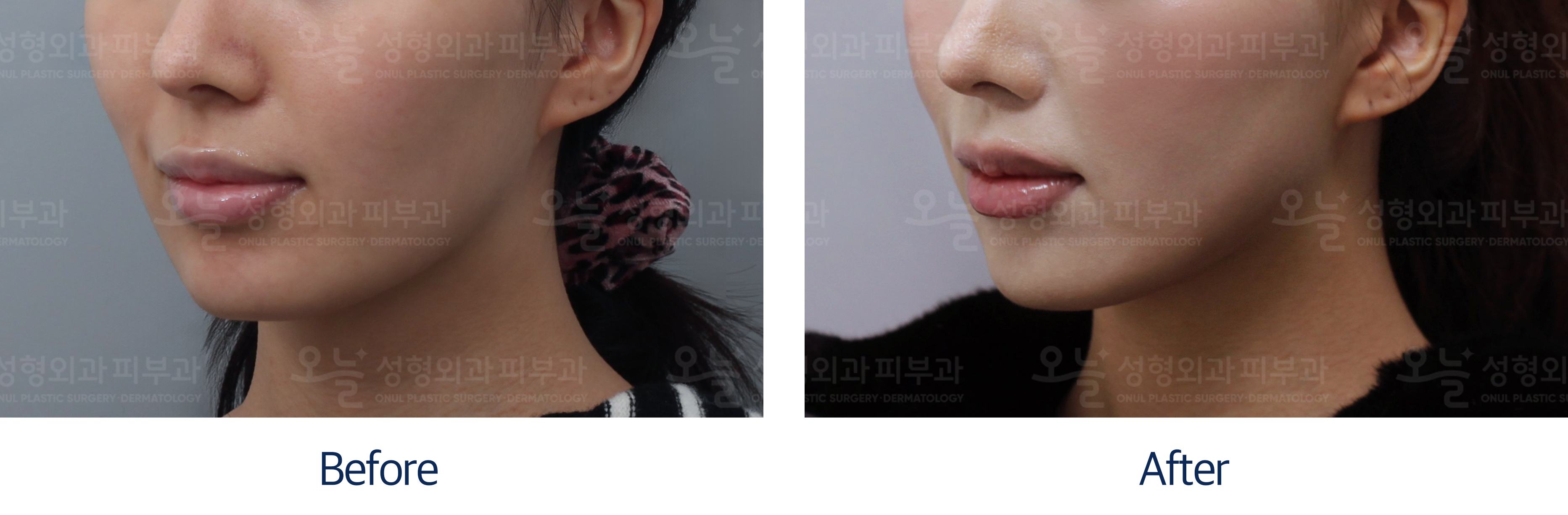 오늘성형외과 전후사진