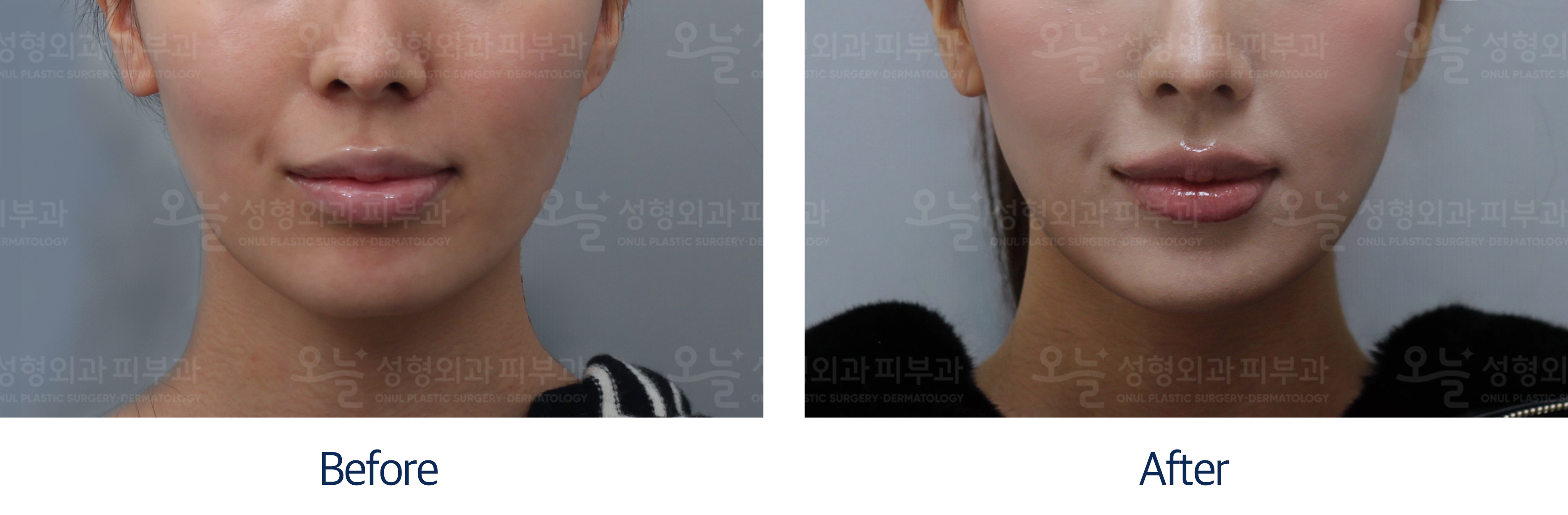 오늘성형외과 전후사진